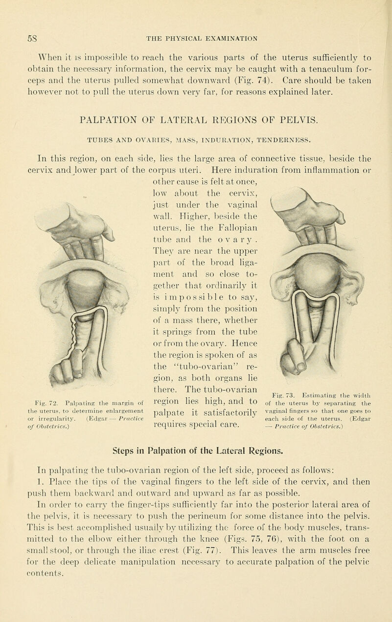 When it is impossible to reach the various parts of the uterus sufficiently to obtain the necessary information, the cervix may be caught with a tenaculum for- ceps and the uterus pulled somewhat downward (Fig. 74). Care should be taken however not to pull the uterus down very far, for reasons explained later. PALPATION OF LATERAL REGIONS OF PELVIS. s TUBES AND OVARIES, MASS, INDURATION, TENDERNESS. In this region, on each side, lies the large area of connective tissue, beside the cervix andjower part of the corpus uteri. Here induration from inflammation or other cause is felt at once, low about the cervix, just under tlie vaginal \ wall. Higher, beside the uterus, lie the Fallopian tube and the ovary. The}^ are near the upper part of the broad liga- ment and so close to- gether that ordinarily it is i m p o s si b 1 e to say, simply from the position of a mass there, whether it springs from the tube or from the ovary. Hence the region is spoken of as the tvibo-ovarian re- gion, as both organs lie there. The tubo-ovarian Fig. 72. Palpating the margin of regiou Hes high, and to the uterus, to determine enlargement nal'Date it Sati^factorilv vaginal fingers so that one goes to or irregularity. (Edgar — Practice . . eacli side of the uterus. (Edgar of Obstetrics.) reqUireS special care. _ practice of obstetrics.) Fig. 73. Estimating the width of the uterus by separating the Steps in Palpation of the Lateral Regions. In palpating the tubo-ovarian region of the left side, proceed as follows: 1. Place the tips of the vaginal fingers to the left side of the cervix, and then push them backward and outwa.rd and upward as far as possible. In order to carry the finger-tips sufficiently far into the posterior lateral area of the pelvis, it is necessary to push the perineum for some distance into the pelvis. This is best accomplished usually by utilizing the force of the body muscles, trans- mitted to the elbow either through the knee (Figs. 75, 76), with the foot on a small stool, or through the iliac crest (Fig. 77). This leaves the arm muscles free for the deep delicate manipulation necessary to accurate palpation of the pelvic contents.