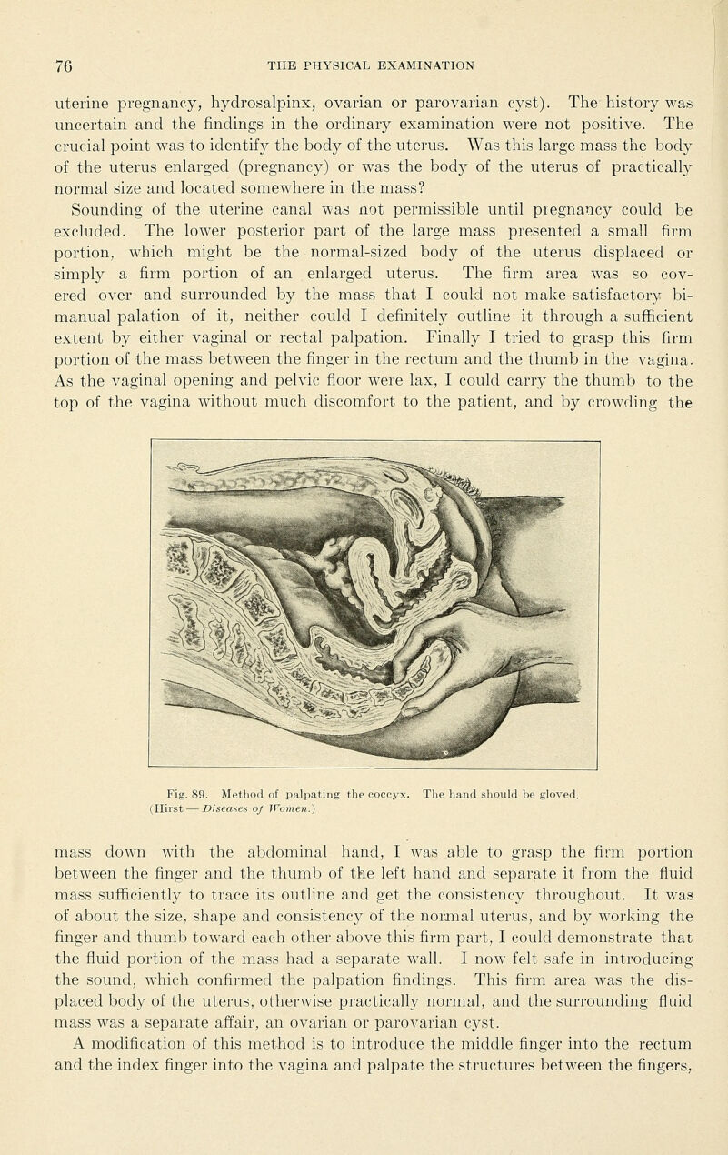 uterine pregnancy, hydrosalpinx, ovarian or parovarian cyst). The history was uncertain and the findings in the ordinary examination were not positive. The crucial point was to identify the body of the uterus. Was this large mass the body of the uterus enlarged (pregnancy) or was the body of the uterus of practically normal size and located somewhere in the mass? Sounding of the uterine canal was not permissible until piegnancy could be excluded. The lower posterior part of the large mass presented a small firm portion, which might be the normal-sized body of the uterus displaced or simply a firm portion of an enlarged uterus. The firm area was so cov- ered over and surrounded by the mass that I could not make satisfactory bi- manual palation of it, neither could I definitely outline it through a sufficient extent by either vaginal or rectal palpation. Finally I tried to grasp this firm portion of the mass between the finger in the rectum and the thumb in the vagina. As the vaginal opening and pelvic floor were lax, I could carry the thumb to the top of the vagina without much discomfort to the patient, and by crowding the Fig. 89. Method of palpating the coccyx. The hand should be gloved. (Hirst — Diseaaes of Women.) mass down with the abdominal hand, I was able to grasp the firm portion between the finger and the thumb of the left hand and separate it from the fluid mass sufficiently to trace its outline and get the consistency throughout. It was of about the size, shape and consistency of the normal uterus, and by working the finger and thumb toward each other above this firm part, I could demonstrate that the fluid portion of the mass had a separate wall. I now felt safe in introducing the sound, which confirmed the palpation findings. This firm area was the dis- placed body of the uterus, otherwise practically normal, and the surrounding fluid mass was a separate affair, an ovarian or parovarian cyst. A modification of this method is to introduce the middle finger into the rectum and the index finger into the vagina and palpate the structures between the fingers,