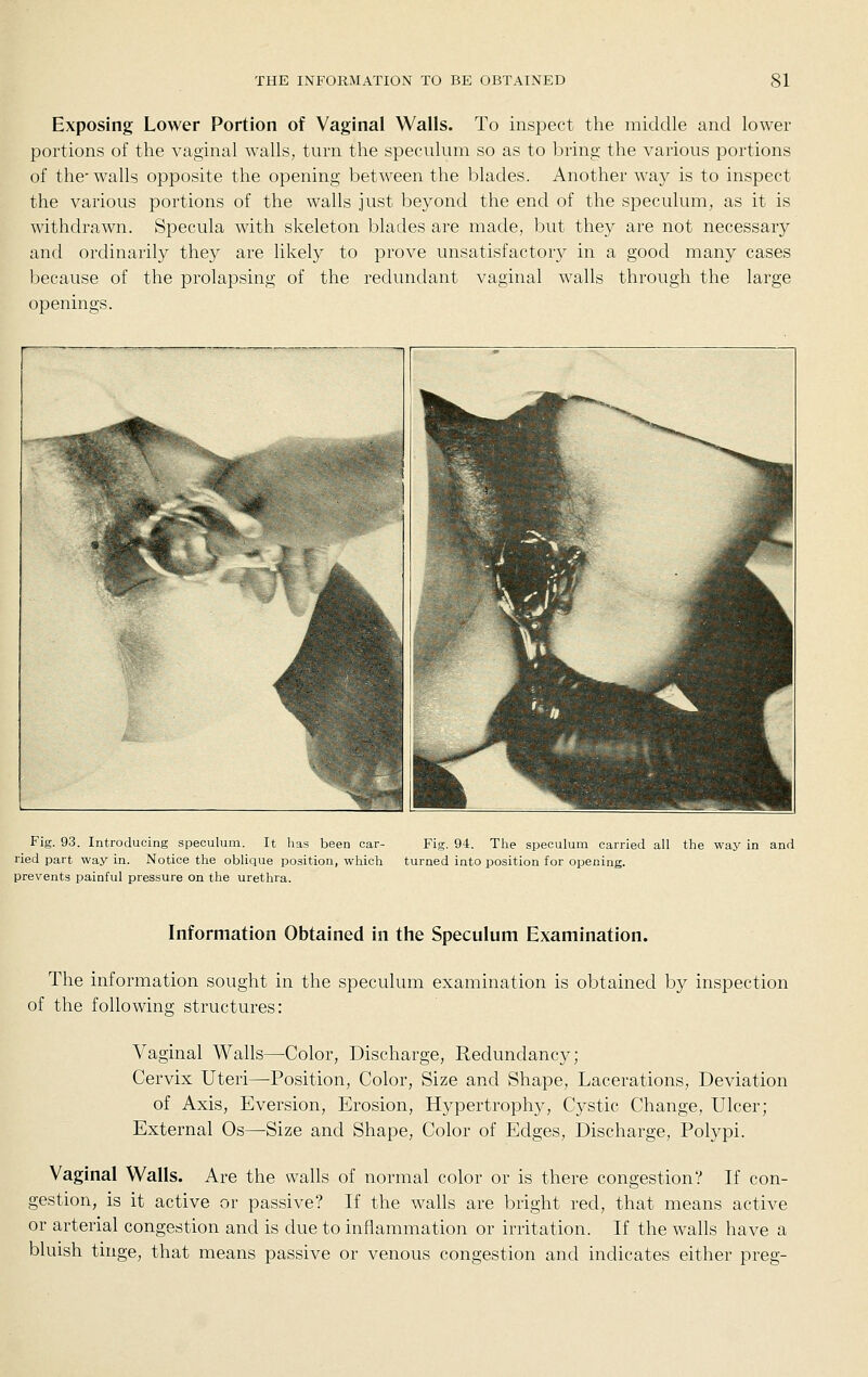 Exposing Lower Portion of Vaginal Walls. To inspect the middle and lower portions of the vaginal walls, turn the speculum so as to bring the various portions of the' walls opposite the opening between the blades. Another way is to inspect the various portions of the walls just beyond the end of the speculum, as it is withdrawn. Specula with skeleton blades are made, but they are not necessary and ordinarily they are likely to prove unsatisfactory in a good many cases because of the prolapsing of the redundant vaginal walls through the large openings. Fig. 93. Introducing speculum. It lias been car- Fig. 94. Tlie speculum carried all the way in and ried part way in. Notice the oblique position, which turned into position for opening, prevents painful pressure on the urethra. Information Obtained in the Speculum Examination. The information sought in the speculum examination is obtained by inspection of the following structures: Vaginal Walls—Color, Discharge, Redundancy; Cervix Uteri—Position, Color, Size and Shape, Lacerations, Deviation of Axis, Eversion, Erosion, Hypertrophy, Cystic Change, Ulcer; External Os—Size and Shape, Color of Edges, Discharge, Polypi. Vaginal Walls. Are the walls of normal color or is there congestion? If con- gestion, is it active or passive? If the walls are bright red, that means active or arterial congestion and is due to inflammation or irritation. If the walls have a bluish tinge, that means passive or venous congestion and indicates either preg-