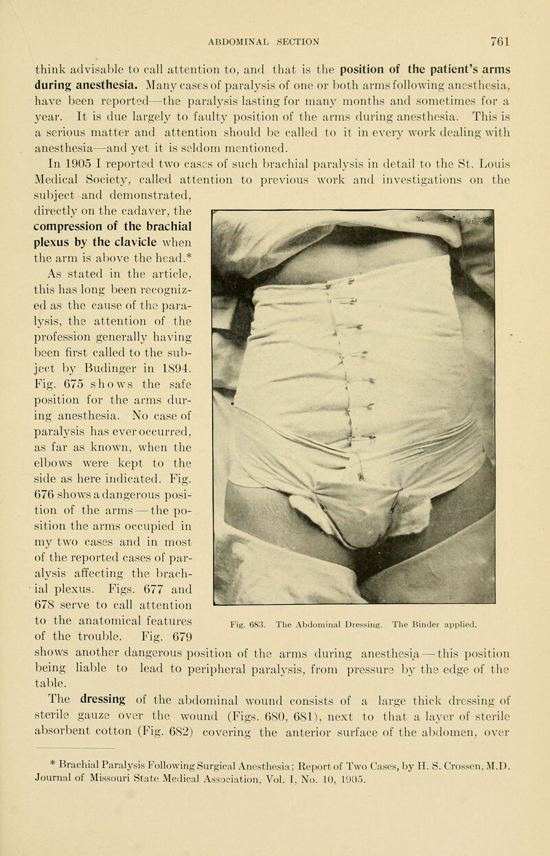 think advisable to call attention to, and that is the position of the patient's arms during anesthesia. Many cases of paralysis of one or both arms following anesthesia, have been reported—the paralysis lasting for many months and sometimes for a year. It is due largely to faulty position of the arms during anesthesia. This is a serious matter and attention should be called to it in every work dealing with anestliesia—and yet it is seldom mentioned. In 1905 I reported two cases of such brachial paralysis in detail to the St. Louis Medical Society, called attention to previous work and investigations on the subject and demonstrated, directly on the cadaver, the compression of the brachial plexus by the clavicle when the arm is above the head.* As stated in the article, this has long been recogniz- ed as the cause of the para- lysis, the attention of the profession generally having been first called to the sub- ject by Budinger in 1894. Fig. 675 shows the safe position for the arms dur- ing anesthesia. No case of paralysis has ever occurred, as far as known, when the elbows were kept to the side as here indicated. Fig. 676 shows a dangerous posi- tion of the arms — the po- sition tlie arms occupied in my two cases and in most of the reported cases of par- alysis affecting the brach- ial plexus. Figs. 677 and 678 serve to call attention to the anatomical features of the trouble. Fig. 679 shows another dangerous position of the arms during anesthesia — this position being liable to lead to peripheral paralysis, from pressure by the edge of the table. The dressing of the abdominal wound consists of a large thick dressing of sterile gauze over the wound (Figs. 680, 681), next to that a layer of sterile absorbent cotton (Fig. 682) covering the anterior surface of tlie abdomen, over Fig. 683. The Abdominal Dressing. The Binder applied. * Brachial Paralysis Following Surgical Anesthesia; Report of Two Cases, by H. S. Crossen, M.D. Journal of Missouri State Medical Association, Vol. I, No. 10, 1905.