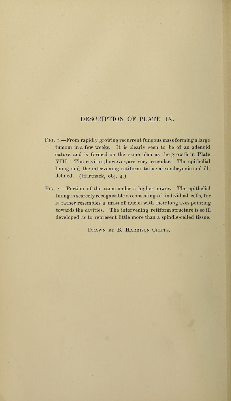 Fig. i.—From rapidly growing recurrent fungous mass forming a large tumour in a few weeks. It is clearly seen to be of an adenoid nature, and is formed on the same plan as the growth in Plate VIII. The cavities, however, are very irregular. The epithelial lining and the intervening retif orm tissue are embryonic and ill- defined. (Hartnack, obj. 4.) Fig. 2.—Portion of the same under a higher power. The epithelial lining is scarcely recognisable as consisting of individual cells, for it rather resembles a mass of nuclei with their long axes pointing towards the cavities. The intervening retif orm structure is so ill developed as to represent little more than a spindle-celled tissue.