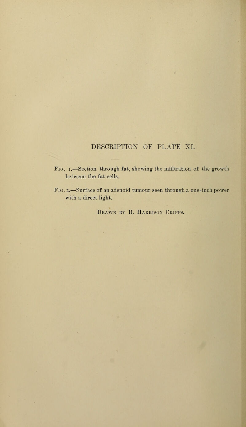 Fig. i.—Section through fat, showing the infiltration of the growth between the fat-cells. Fig. 2.—Surface of an adenoid tumour seen through a one-inch power with a direct light.
