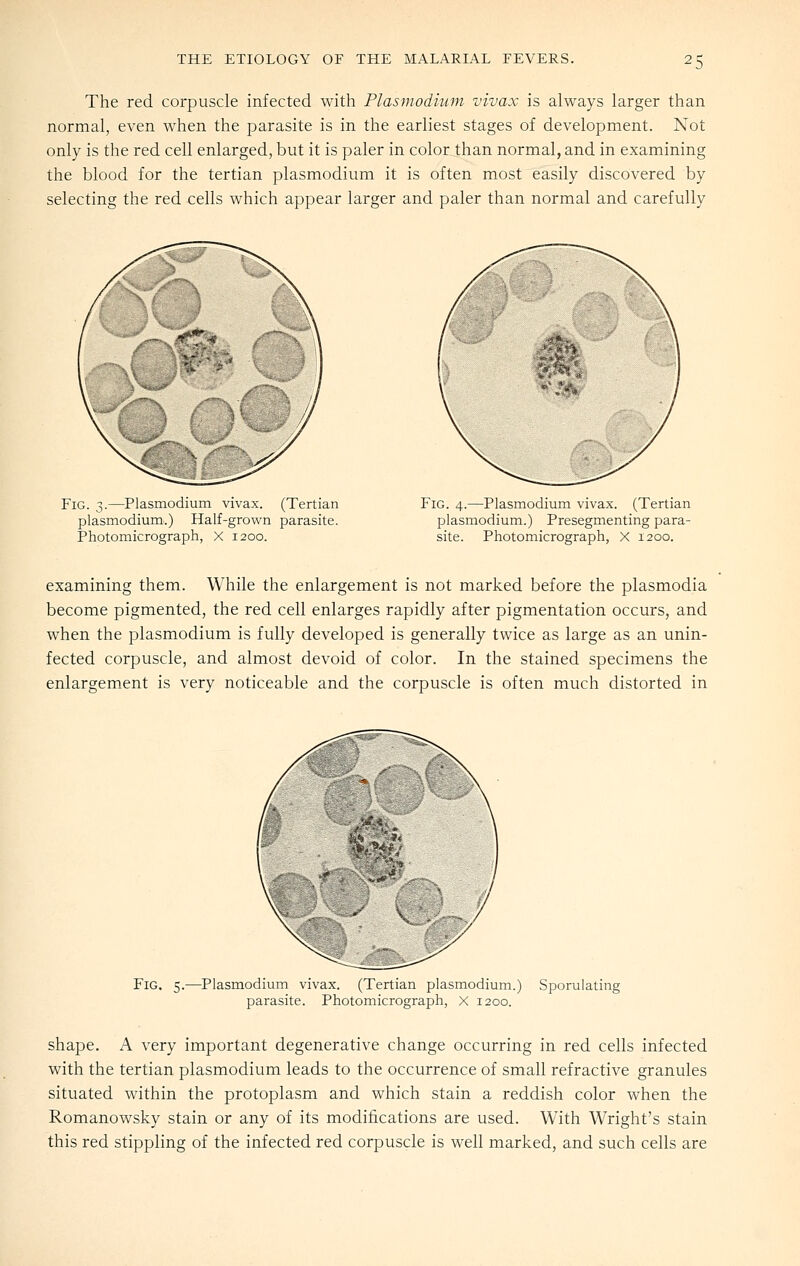 The red corpuscle infected with Plasmodium vivax is always larger than normal, even when the parasite is in the earliest stages of development. Not only is the red cell enlarged, but it is paler in color than normal, and in examining the blood for the tertian plasmodium it is often most easily discovered by selecting the red cells which appear larger and paler than normal and carefully Fig. 3.—Plasmodium vivax. (Tertian Plasmodium.) Half-grown parasite. Photomicrograph, X 1200. Fig. 4.—Plasmodium vivax. (Tertian Plasmodium.) Presegmenting para- site. Photomicrograph, X 1200. examining them. While the enlargement is not marked before the plasmodia become pigmented, the red cell enlarges rapidly after pigmentation occurs, and when the plasmodium is fully developed is generally twice as large as an unin- fected corpuscle, and almost devoid of color. In the stained specimens the enlargement is very noticeable and the corpuscle is often much distorted in Fig. 5. -Plasmodium vivax. (Tertian plasmodium.) Sporulating parasite. Photomicrograph, X 1200. shape. A very important degenerative change occurring in red cells infected with the tertian plasmodium leads to the occurrence of small refractive granules situated within the protoplasm and which stain a reddish color when the Romanowsky stain or any of its modifications are used. With Wright's stain this red stippling of the infected red corpuscle is well marked, and such cells are