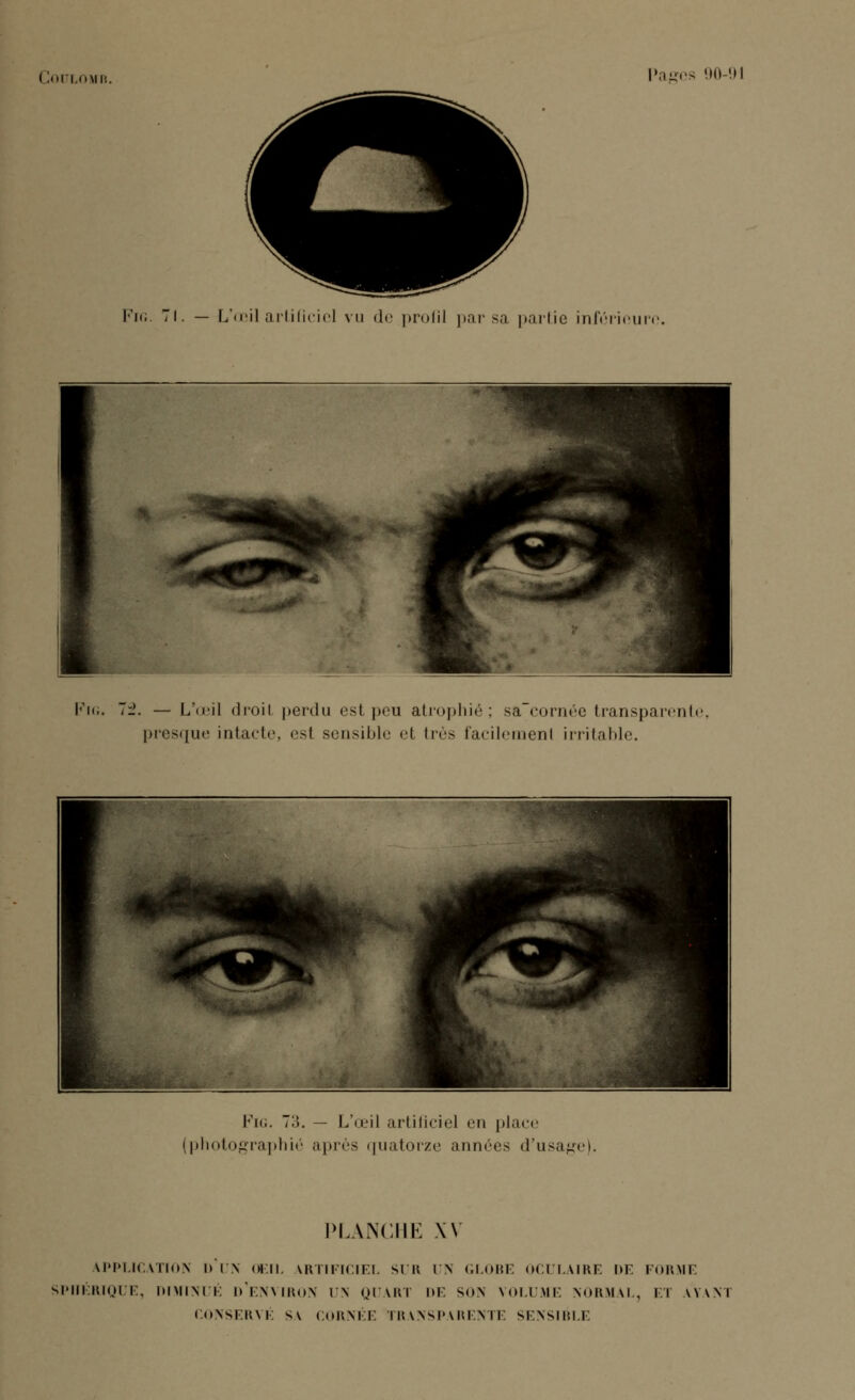 Fig. 71. — L'œil artificiel vu de profil par sa partie inférieure. Fig. ~±. — L'œil droit perdu est peu atrophié : sa cornée transparent presque intacte esl sensible el très facilemenl irritable. Fig. 7o. — L'œil artificiel en place (photographié après quatorze années d'usage). PLANCHE XV APPLICATION I» UN OEIL ARTIFICIEL SUR UN GLOBE OCULAIRE I)F. FORME SPIIÉRIQUE, DIMINUÉ D'ENVIRON UÎS QUART DE SON VOLUME NORMAL, ET \\\\ï CONSERVÉ s\ CORNÉE TRANSPARENTE SENSIBLE