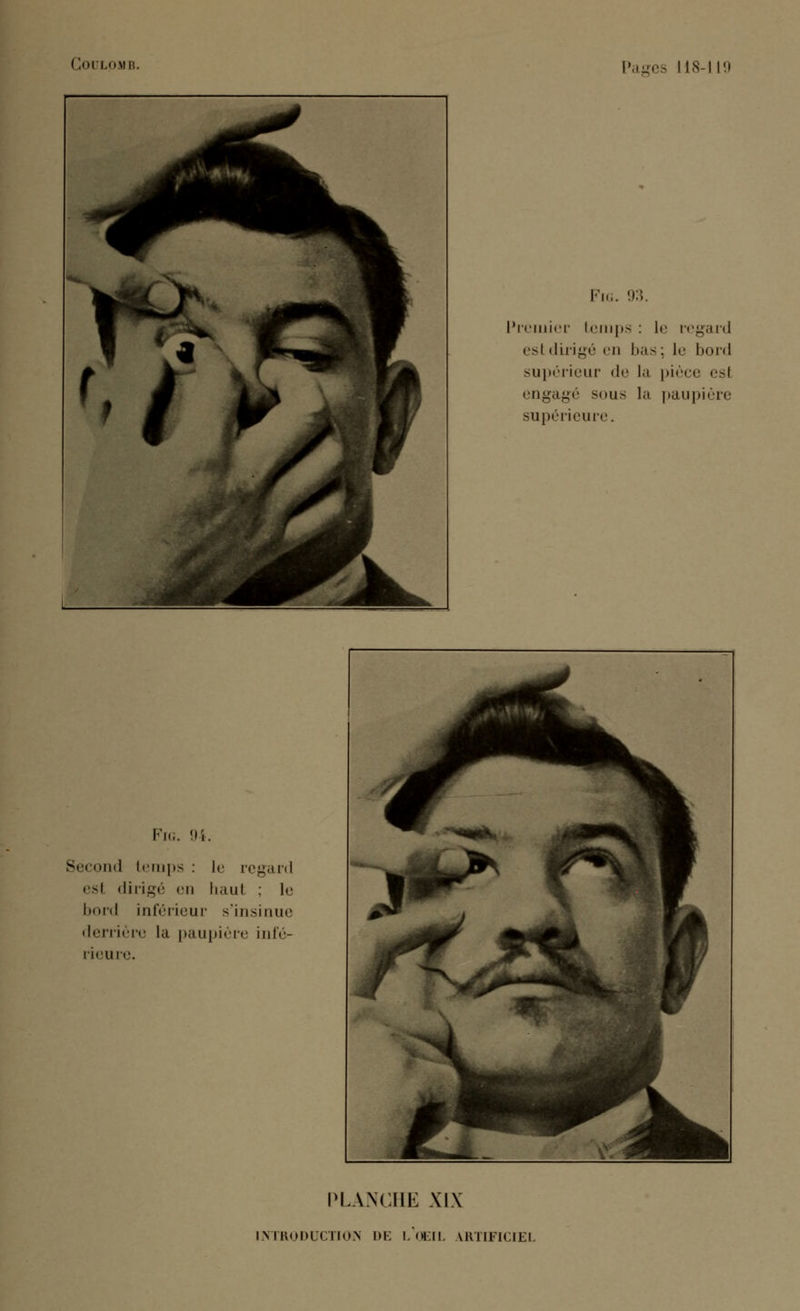 I loi LOMB. Second temps : le regard esl dirigé en haut : le bord inférieur s'insinue derrière la paupière infé- rieure. PLANCHE XIX