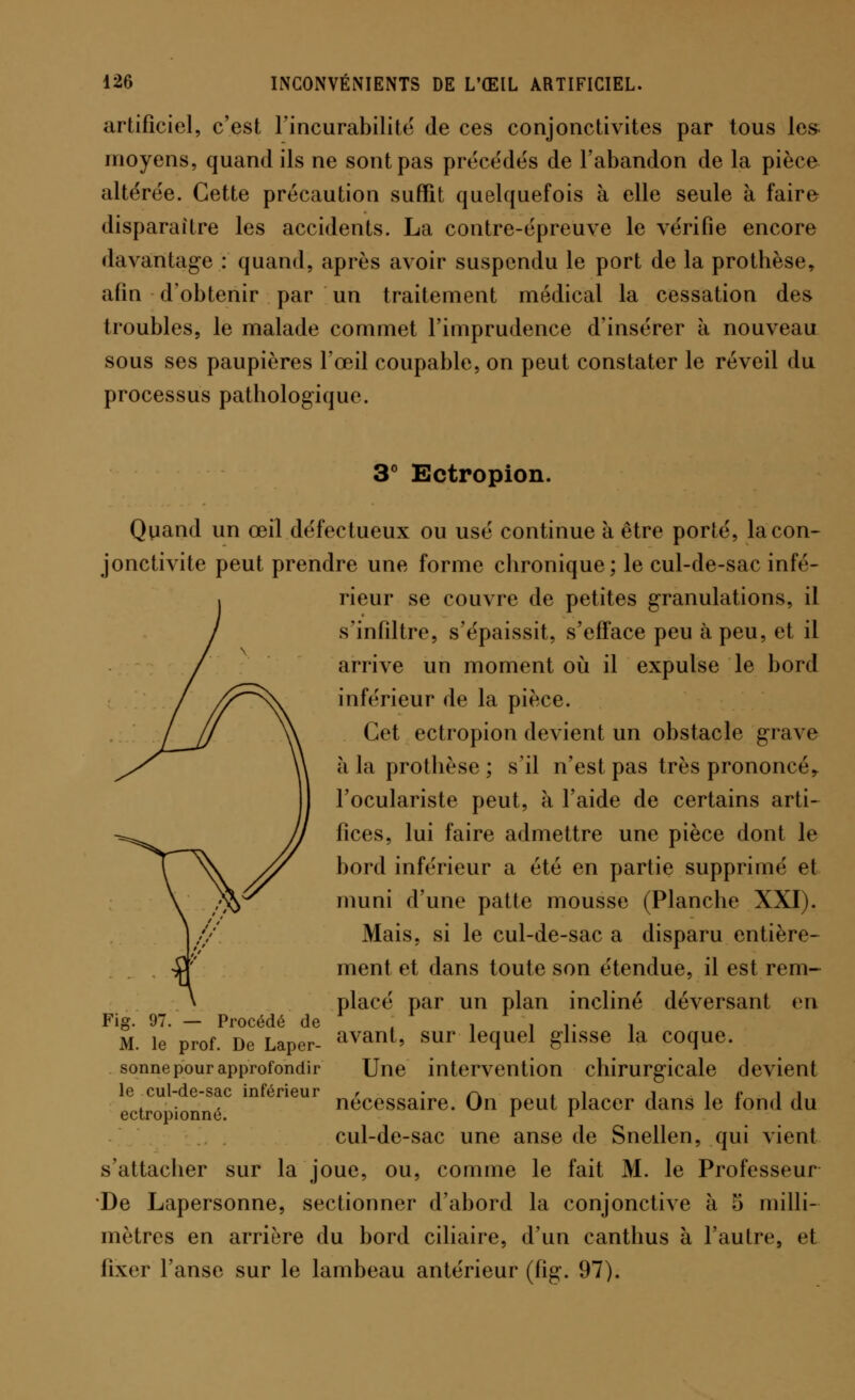 artificiel, c'est l'incurabilité de ces conjonctivites par tous les moyens, quand ils ne sont pas précédés de l'abandon de la pièce altérée. Cette précaution suffit quelquefois à elle seule à faire disparaître les accidents. La contre-épreuve le vérifie encore davantage : quand, après avoir suspendu le port de la prothèse, afin d'obtenir par un traitement médical la cessation des troubles, le malade commet l'imprudence d'insérer à nouveau sous ses paupières l'œil coupable, on peut constater le réveil du processus pathologique. 3° Ectropion. Quand un œil défectueux ou usé continue à être porté, la con- jonctivite peut prendre une forme chronique; le cul-de-sac infé- rieur se couvre de petites granulations, il s'infiltre, s'épaissit, s'efface peu à peu, et il arrive un moment où il expulse le bord inférieur de la pièce. Cet ectropion devient un obstacle grave à la prothèse ; s'il n'est pas très prononcé* l'oculariste peut, à l'aide de certains arti- fices, lui faire admettre une pièce dont le bord inférieur a été en partie supprimé et muni d'une patte mousse (Planche XXI). Mais, si le cul-de-sac a disparu entière- ment et dans toute son étendue, il est rem- placé par un plan incliné déversant en Fi» 97 Procédé de M. le' prof. De Laper- avant> sur lequel £lisse la C0(lue- sonne pour approfondir Une intervention chirurgicale devient le cul-de-sac inférieur , - r\ î j î e ■ j j . . j nécessaire. On peut placer dans le lond du cul-de-sac une anse de Snellen, qui vient s'attacher sur la joue, ou, comme le fait M. le Professeur De Lapersonne, sectionner d'abord la conjonctive à 5 milli- mètres en arrière du bord ciliaire, d'un canthus à l'autre, et Qxer l'anse sur le lambeau antérieur (fig. 97).