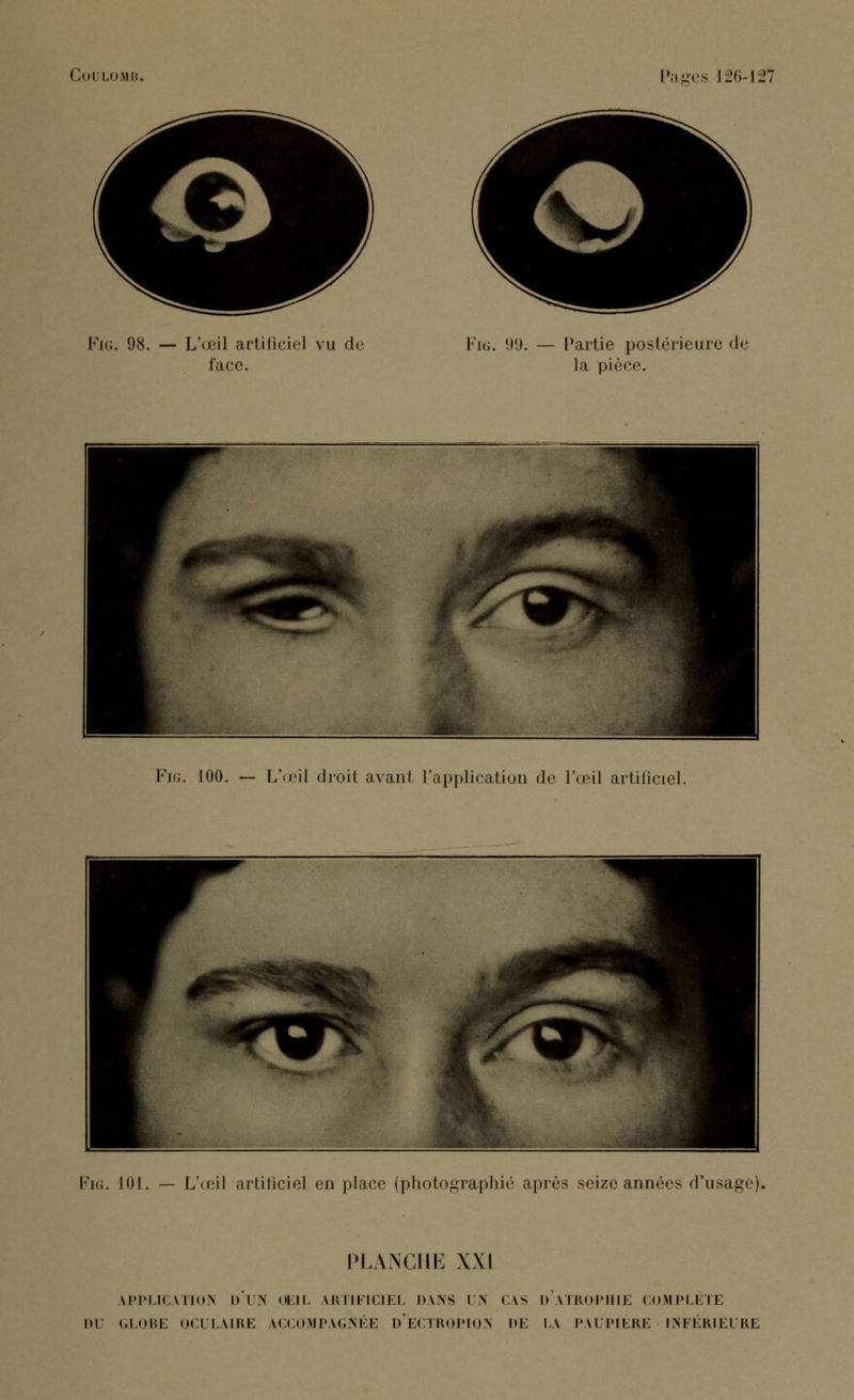 Fit;. 98. — L'œil artificiel vu d< face. Fig. 99. — Partie postérieure de la pièce. Fig. 100. — L'œil droit avant l'application de l'œil artificiel. Fig. 101. — Ln'il artificiel en place (photographié après seize années d'usage)* PLANCHE XXI APPLICATIOIN I) I N OEIL ARTIFICIEL l>Ws |\ CAS D ATROPHIE COMPLETE l»l GLOBE OCULAIRE ACCOMPAGNÉE d'eCTROPIOS DE LA PAUPIÈRE INFÉRIEURE