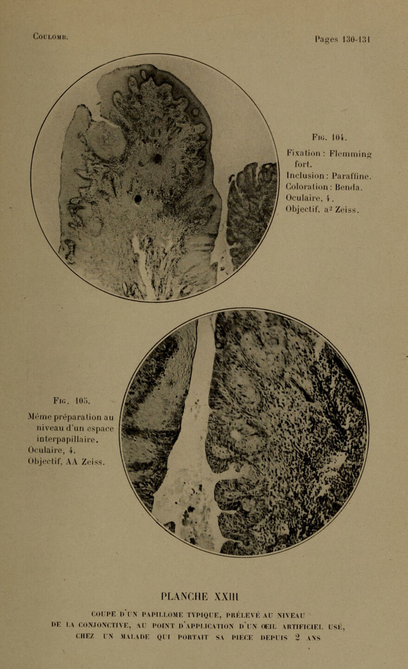 i!oi i.«Mii!. Fi.;. 104. Fixation : Flemming fort. Inclusion: Paraffine. Coloration : Benda. Oculaire, '». Objectif, .r-' Zciss. Même préparation au niveau d'un espace interpapillaire. Oculaire, 4. Objectif, AA Zeiss. PLANCHE XXIIL COUPE DIX PAPILLOME TYPIQUE, PRÉLEVÉ AU NIVEAU HE LA CONJONCTIVE, W POINT D'APPLICATION l)ï\ OEIL ARTIFICIEL USI CHEZ UN MALADE QUI PORTAIT SV PIÈCE DEPUIS 2 ANS