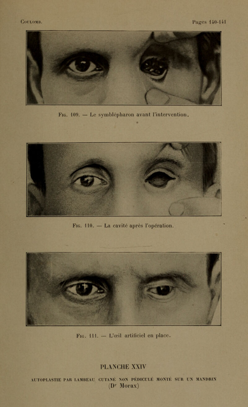 Fig. 109. — Le symblépharon avant l'intervention. Fig. 110. — La cavité après l'opération. Fig. 111. — L'œil artificiel en place. PLANCHE XXIV AUTOPLASTIE PAR LAMBEAU CUTANÉ NON PÉDICULE MONTÉ SUR UN MANDRIN (Dr Morax)