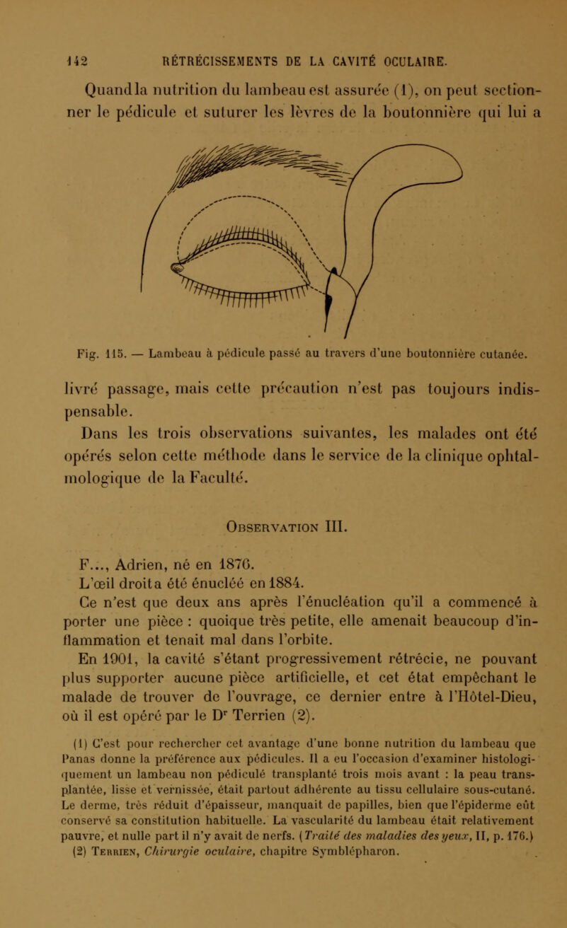 Quand la nutrition du lambeau est assurée (1), on peut section- ner le pédicule et suturer les lèvres de la boutonnière qui lui a Fig. 115. — Lambeau à pédicule passé au travers d'une boutonnière cutanée. livré passage, mais cette précaution n'est pas toujours indis- pensable. Dans les trois observations suivantes, les malades ont été opérés selon cette méthode dans le service de la clinique ophtal- mologique de la Faculté. Observation III. F..., Adrien, né en 1870. L'œil droit a été énucléé en 1884. Ce n'est que deux ans après l'énucléation qu'il a commencé à porter une pièce : quoique très petite, elle amenait beaucoup d'in- flammation et tenait mal dans l'orbite. En 1901, la cavité s'étant progressivement rétrécie, ne pouvant plus supporter aucune pièce artificielle, et cet état empêchant le malade de trouver de l'ouvrage, ce dernier entre à l'Hôtel-Dieu, où il est opéré par le Dr Terrien (2). (1) C'est pour rechercher cet avantage d'une bonne nutrition du lambeau que Panas donne la préférence aux pédicules. Il a eu l'occasion d'examiner histologi- quement un lambeau non pédicule transplanté trois mois avant : la peau trans- plantée, lisse et vernissée, était partout adhérente au tissu cellulaire sous-cutané. Le derme, très réduit d'épaisseur, manquait de papilles, bien que l'épiderme eût conservé sa constitution habituelle. La vascularité du lambeau était relativement pauvre, et nulle part il n'y avait de nerfs. ( Traité des maladies des yeux, II, p. 176.) (2) Terrien, Chirurgie oculaire, chapitre Symblépharon.