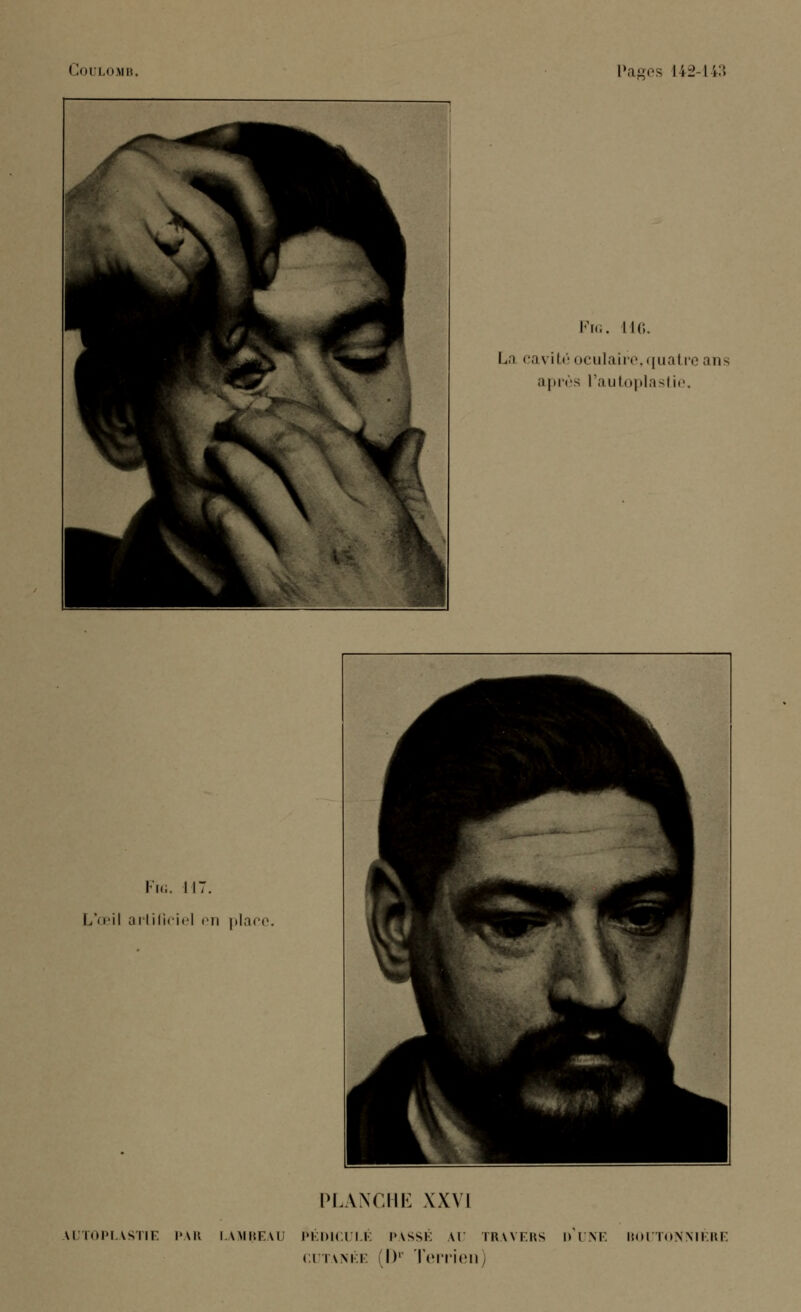 Fig. 116. La cavité oculaire, quatre ans après Fautoplastie, Fig. 117. L'œil artificiel en place PLANCHE XXV] VI ITOP1 VSUF PAR LAMBEAU PÉDICULE PASSÉ VI TRAVERS D'UNE BOUTONNIERE cutanée D1 Terrien)