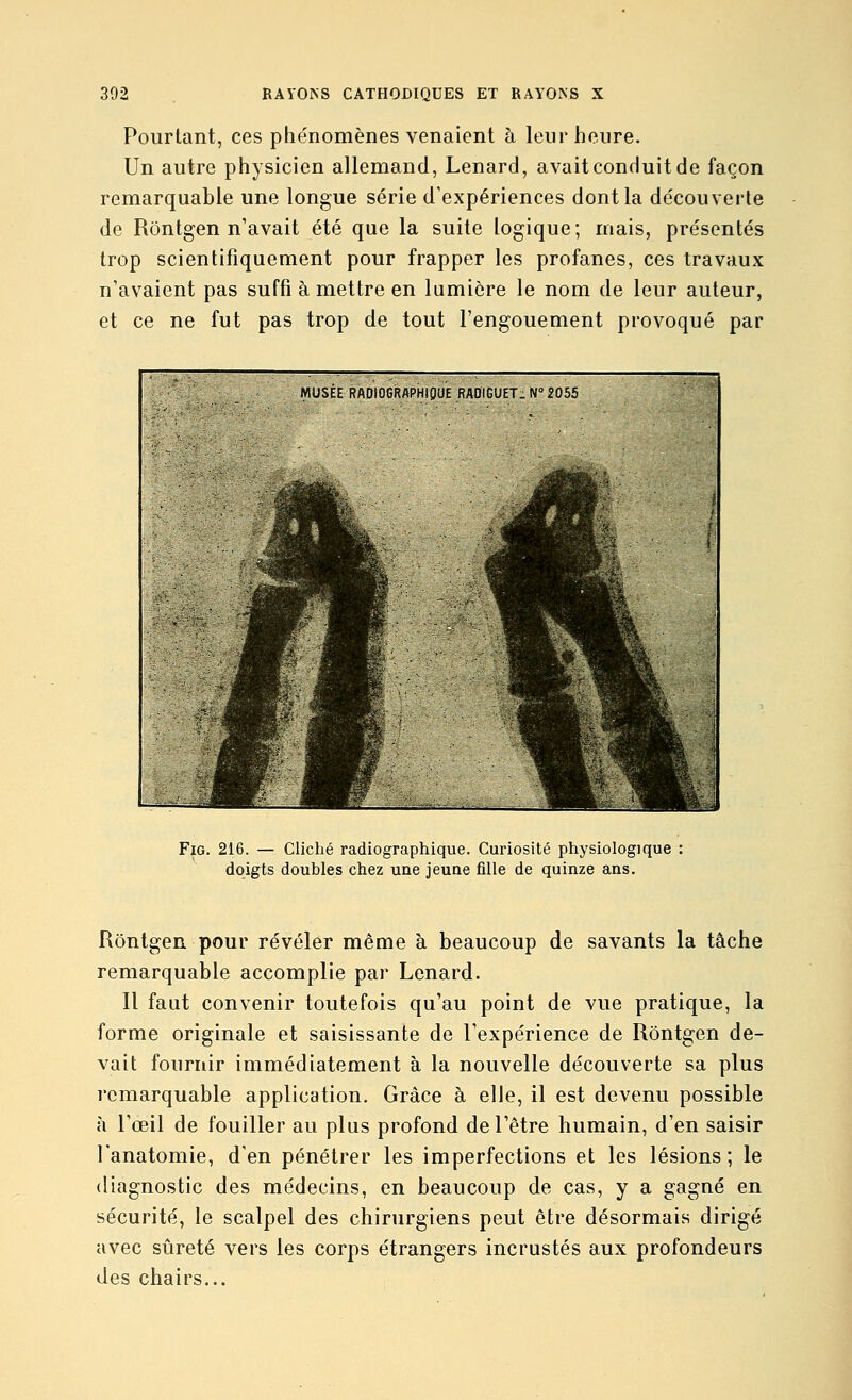 Pourtant, ces phénomènes venaient à leur heure. Un autre physicien allemand, Lenard, avait conduit de façon remarquable une longue série d'expériences dont la découverte de Rôntgen n'avait été que la suite logique; mais, présentés trop scientifiquement pour frapper les profanes, ces travaux n'avaient pas suffi à mettre en lumière le nom de leur auteur, et ce ne fut pas trop de tout l'engouement provoqué par FiG. 216. — Cliché radiographique. Curiosité physiologique doigts doubles chez une jeune fille de quinze ans. Rôntgen pour révéler même à beaucoup de savants la tâche remarquable accomplie par Lenard. Il faut convenir toutefois qu'au point de vue pratique, la forme originale et saisissante de l'expérience de Rôntgen de- vait fournir immédiatement à la nouvelle découverte sa plus remarquable application. Grâce à elle, il est devenu possible à l'œil de fouiller au plus profond de l'être humain, d'en saisir l'anatomie, d'en pénétrer les imperfections et les lésions; le diagnostic des médecins, en beaucoup de cas, y a gagné en sécurité, le scalpel des chirurgiens peut être désormais dirigé avec sûreté vers les corps étrangers incrustés aux profondeurs des chairs...