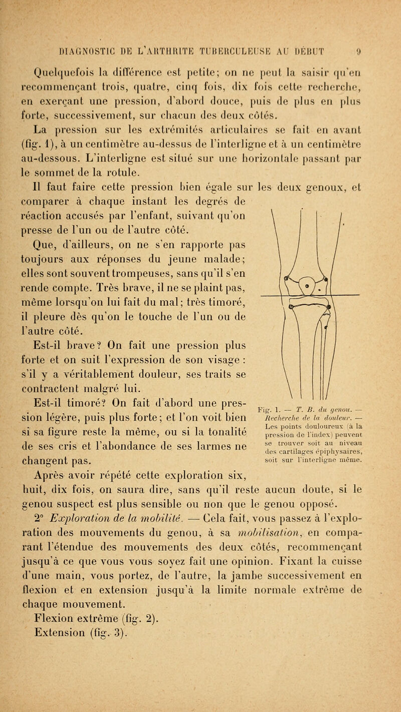 Quel(iucfoi.s la différence est petite; on ne peut la saisir qu'en recommençant trois, quatre, cinq fois, dix fois cette recherche, en exerçant une pression, d'ahord douce, puis de plus en plus forte, successivement, sur chacun des deux côtés. La pression sur les extrémités articulaires se fait en avant (fig. 1), à un centimètre au-dessus de Finlerlig-neet à un centimètre au-dessous. L'interligne est situé sur une horizontale passant par le sommet de la rotule. Il faut faire cette pression hien égale sur les deux genoux, et comparer à chaque instant les degrés de réaction accusés par l'enfant, suivant qu'on presse de l'un ou de l'autre côté. Que, d'ailleurs, on ne s'en rapporte pas toujours aux réponses du jeune malade; elles sont souvent trompeuses, sans qu'il s'en rende compte. Très brave, il ne se plaint pas, même lorsqu'on lui fait du mal; très timoré, il pleure dès qu'on le touche de l'un ou de l'autre côté. Est-il brave? On fait une pression plus forte et on suit l'expression de son visage : s'il y a véritablement douleur, ses traits se Fig-. 1. — T. B. du genou. — Recherche de la douleur. — Les points douloureux 'à la pression de l'index) peuvent se trouver soit au niveau des cartilages épiphysaires, soit sur l'interligne même. contractent malgré lui. Est-il timoré? On fait d'abord une pres- sion légère, puis plus forte; et l'on voit bien si sa figure reste la même, ou si la tonalité de ses cris et l'abondance de ses larmes ne changent pas. Après avoir répété cette exploration six, huit, dix fois, on saura dire, sans qu'il reste aucun doute, si le genou suspect est plus sensible ou non que le genou opposé. 2° Exjiloration de la mobilité. — Cela fait, vous passez à l'explo- ration des mouvements du genou, à sa mobilisation, en compa- rant l'étendue des mouvements des deux côtés, recommençant jusqu'à ce que vous vous soyez fait une opinion. Fixant la cuisse d'une main, vous portez, de l'autre, la jambe successivement en flexion et en extension jusqu'à la limite normale extrême de chaque mouvement. Flexion extrême (fîg. 2). Extension (fig. 3).