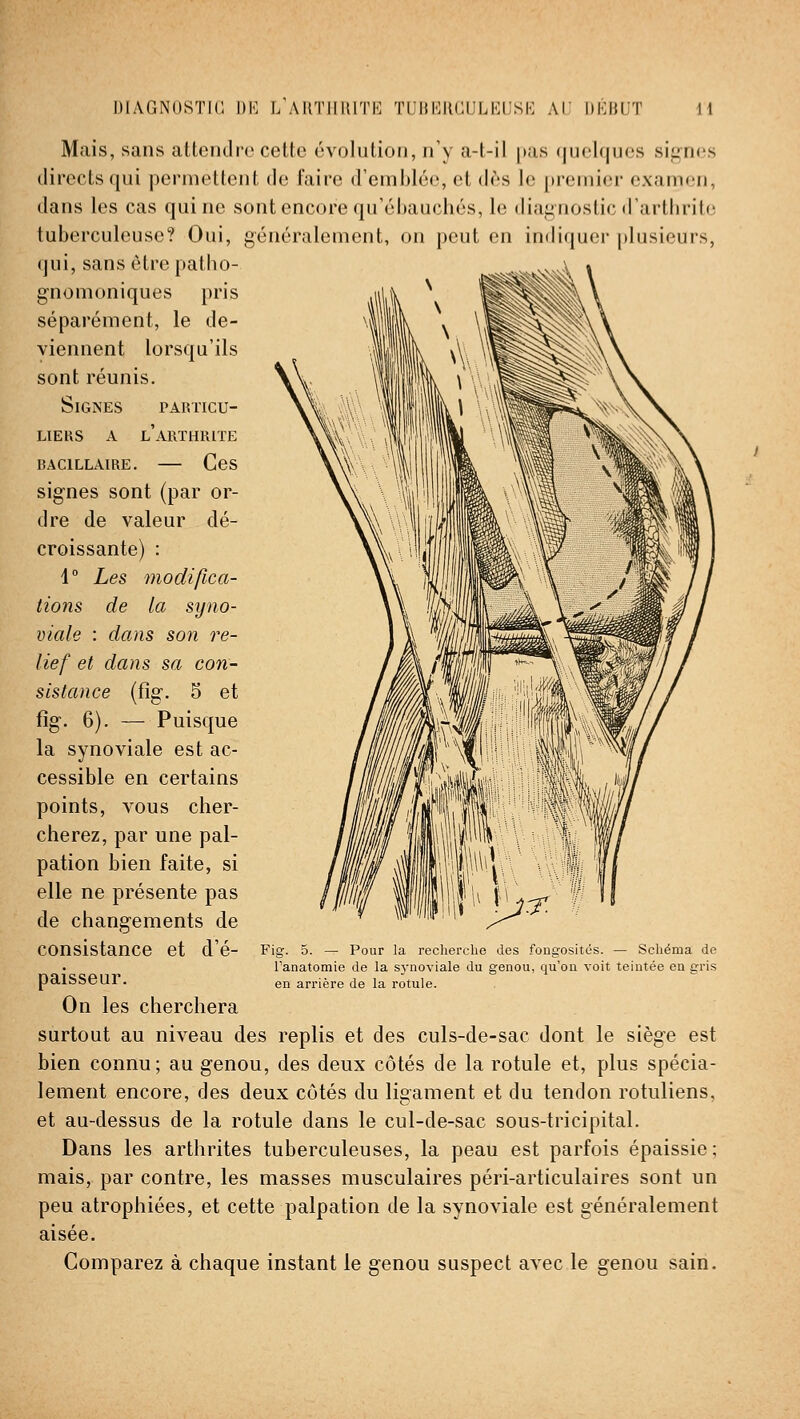 Mais, sans attendre cette évolution, n'y a-l-il [las <juclques signes directs qui permettent de faire d'emijléo, et dès le premier examen, dans les cas qui ne sont encore qn'6l)auchés, le diaj^nostic fl'arllirito tuberculeuse? Oui, généralement, on peut en indiquer plusieurs, qui, sans être patho- gnomoniques pris séparément, le de- viennent lorsqu'ils sont réunis. Signes particu- liers A l'arthrite BACILLAIRE. CcS signes sont (par or- dre de valeur dé- croissante) : 4 ° Les modifica- tions de la syno- viale : dans son re- lief et dans sa con- sistance (fig. 5 et fîg. 6). — Puisque la synoviale est ac- cessible en certains points, vous cher- cherez, par une pal- pation bien faite, si elle ne présente pas de changements de consistance et d'é- Flg. s. — Pour la recherche des fougosités. — Schéma de Tanatomie de la synoviale du genou, qu'on voit teintée en gris paiSSeur. ^^ arrière de la rotule. On les cherchera surtout au niveau des replis et des culs-de-sac dont le siège est bien connu; au genou, des deux côtés de la rotule et, plus spécia- lement encore, des deux côtés du ligament et du tendon rotuliens, et au-dessus de la rotule dans le cul-de-sac sous-tricipital. Dans les arthrites tuberculeuses, la peau est parfois épaissie; mais, par contre, les masses musculaires péri-articulaires sont un peu atrophiées, et cette palpation de la synoviale est généralement aisée. Comparez à chaque instant le genou suspect avec le genou sain.