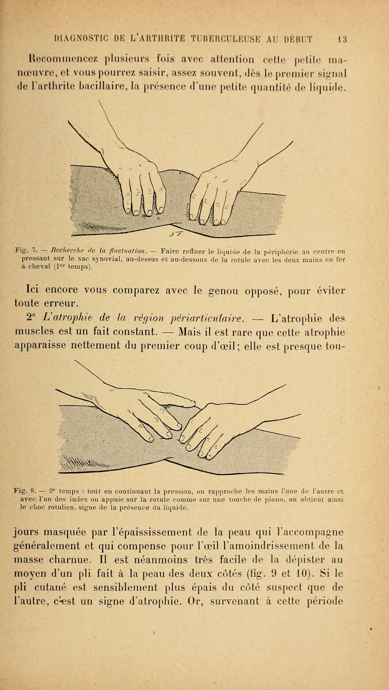 HecomiiKMicez plusieurs fois avec altenlion celle pelilii ma- nœuvre, et vous pourrez saisir, assez souvent, dès le premier sif.Mial lie l'arthrite bacillaire, la présence d'une petite quantité de Ii(]uide. y^g- '■ — Recherche de la fluctuation. — Faire refluer le liquide de la périphérie au centre en pressant sur le sac synovial, au-dessus et au-dessous de la rotule avec les deux mains en fer à cheval (!«■• temps). Ici encore vous comparez avec le genou opposé, pour éviter toute erreur. 2° L'atrophie de la région j)ériarticulaire. — L'atrophie des muscles est un fait constant. — Mais il est rare que cette atrophie apparaisse nettement du premier coup d'œil; elle est presque tou- Fig. 8. — 2 temps : tout en continuant la pression, on rapproche les mains l'une de l'autre et avec l'un des index ou appuie sur la rotule comme sur une touche de piano, on obtient ainsi le choc rotulien, signe de la présence du liquide. jours masquée par l'épaississement de la peau qui l'accompagne généralement et qui compense pour l'œil l'amoindrissement de la masse charnue. Il est néanmoins très facile de la dépister au moyen d'un pli fait à la peau des deux côtés (fîg. 9 et 10). Si le pli cutané est sensiblement plus épais du côté suspect que de l'autre, c^st un signe d'atrophie. Or, survenant à cette période