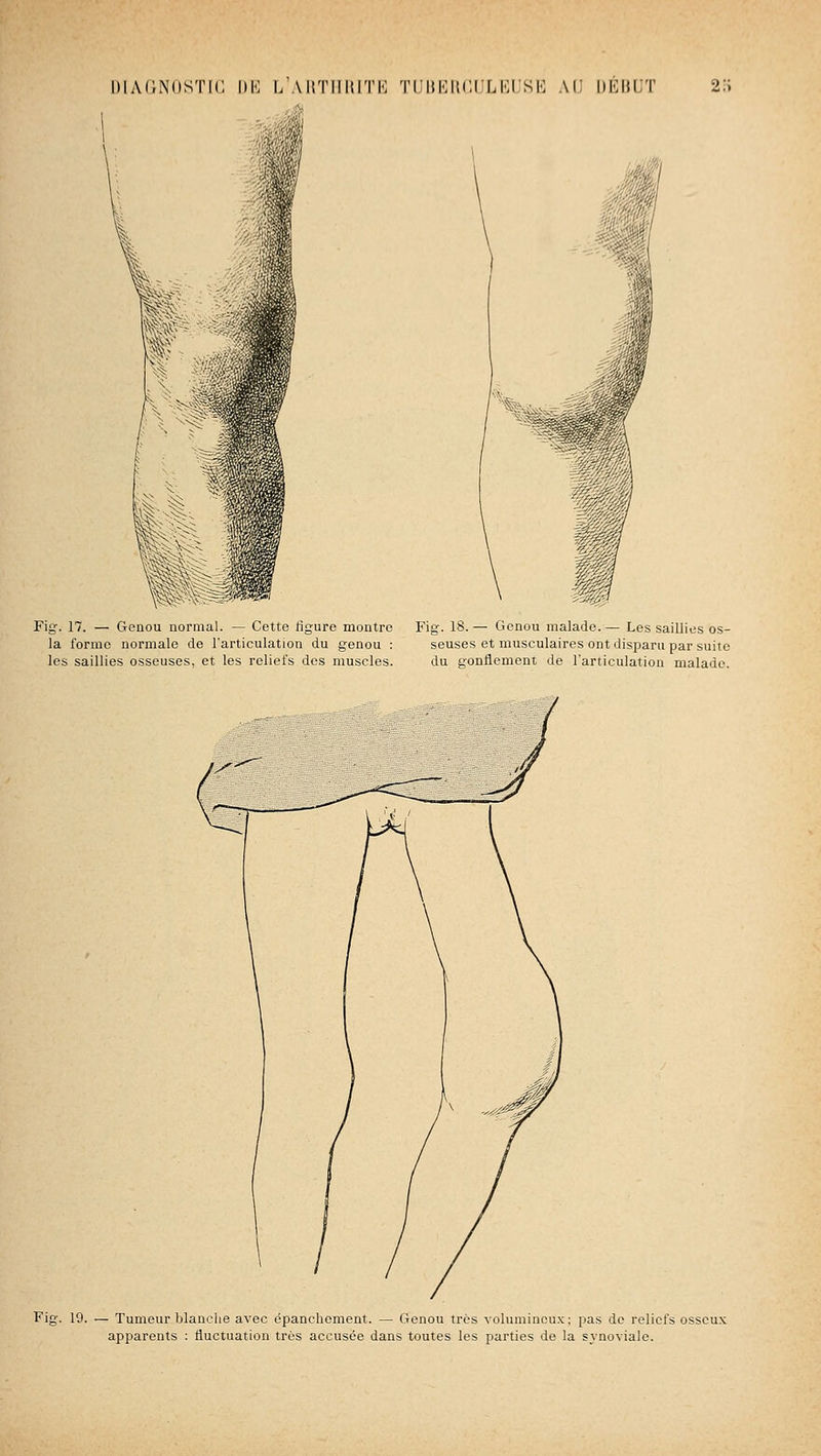 niAUNiisrii i»i: l'\1!TI1I{it1'; TiMiKiiciiLKisK AU DÉuuT 2:; Fig-. 17. — Genou normal. — Cette ligure montre la forme normale de l'articulation du genou : les saillies osseuses, et les reliefs des muscles. Fig. 18. — Genou malade. — Les saillies os- seuses et musculaires ont disparu par suite du gonflement de l'articulation malade. Fif 19. — Tumeur blanche avec épanchcment. — Genou très volumineux; pas do reliefs osseux apparents : fluctuation très accusée dans toutes les parties de la synoviale.