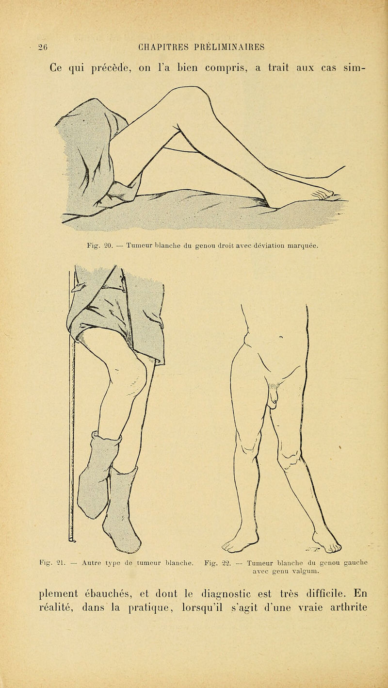 Ce qui précède, on l'a bien compris, a trait aux cas sim- /^- \ Fig. 20. — Tumeur blanche du genou droit avec déviation marquée. Fig. 21. — Autre type de tumeur blanche. Fig. 22. — Tumeur blanche du genou gauche avec genu valgum. plement ébauchés, et dont le diagnostic est très difficile. En réalité, dans la pratique, lorsqu'il s'agit d'une vraie arthrite