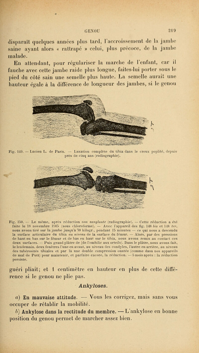 disparaît quelques années [)1ms tard, raecroisseinent de la. jainl)(î saine ayant alors « rattrapé » celui, i)lus précuce, de la jainite malade. En attendant, pour régulariser la marche de l'enfant, car il fauche avec cette jambe raide plus longue, faites-lui porter sous le pied du côté sain une semelle plus haute. La semelle aurait une hauteur égale à la différence de longueur des jambes, si le genou Fig-. 1-19. — Lucien L. de Paris. — Luxation complète du tibia dans le creux poplité, depuis près de cinq ans (radiographie). i«^'^sfeSs|:^^^'*ïi-»iS553 ''^^^S^ Fig. 150. — Le même, après réduction non sanglante' (radiographie). — Cette réduction a été faite le 18 novembre 1S05 (sous chloroforme). — Avec Fappareil des fig. 148 bis et 148 <er, nous avons tiré sur la jambe jusqu'à 70 kilogr., pendant 15 minutes — ce qui nous a descendu la surface articulaire du tibia au niveau de la surface du fémur. — Alors, par des pressions de haut en bas sur le fémur et de bas en haut sur le tibia, nous avons remis au contact ces deux surfaces. — Puis grand plâtre de (de l'ombilic aux orteils). Dans le plâtre, nous avons fait, le lendemain, deux fenêtres l'une en avant, au niveau des condyles, l'autre en arrière, au niveau des tubérosités tibiales et par là une double compression ouatée (comme dans nos appareils de mal de Pott) pour maintenir, et parfaire encore, la réduction. —5 mois après : la réduction persiste. guéri pliait; et 1 centimètre en hauteur en plus de cette diffé- rence si le genou ne plie pas. Ankyloses. a) En mauvaise attitude. — Vous les corrigez, mais sans vous occuper de rétablir la mobilité. b) Ankylose dans la rectitude du membre. —L'ankylose en bonne position du genou permet de marcher assez bien.