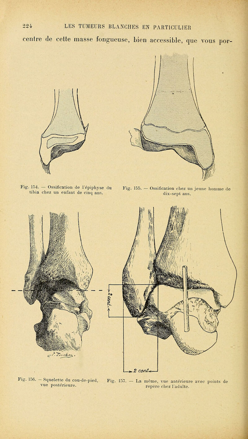 centre de cette masse fongueuse, bien accessible, que vous por- Fig. 154. — Ossification de l'épiphyse du Fig. 155. — Ossification chez un jeune homme de tibia chez un enfant de cinq ans. dix-sept ans. Fig. 156. - Squelette du cou-de-pied, Fig. 157. — La même, vue antérieure avec points de vue postérieure. repère chez l'adulte.