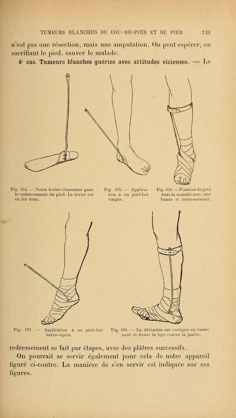 n'est pas une résection, mais une amputation. On peut os[)érer, en sacrifiant le pied, sauver le malade. 4' cas. Tumeurs blanches guéries avec attitudes vicieuses. — Le Fig 164. — Notre levier-chaussure pour Fig. 165. — Applica- Fig. 166. — Fixation du pied le redressement du pied. Le levier est tien à un pied-bot dans la semelle avec une en fer doux. valgus. bande et; redressement. Fig. 167. — Application à un pied-bot Fig. 168. — La déviation est corrigée en rame- varus-équin. nant et fixant la tige contre la jambe. redressement se fait par étapes, avec des plâtres successifs. On pourrait se servir également pour cela de notre appareil figuré ci-contre. La manière de s'en servir est indiquée sur ces figures.