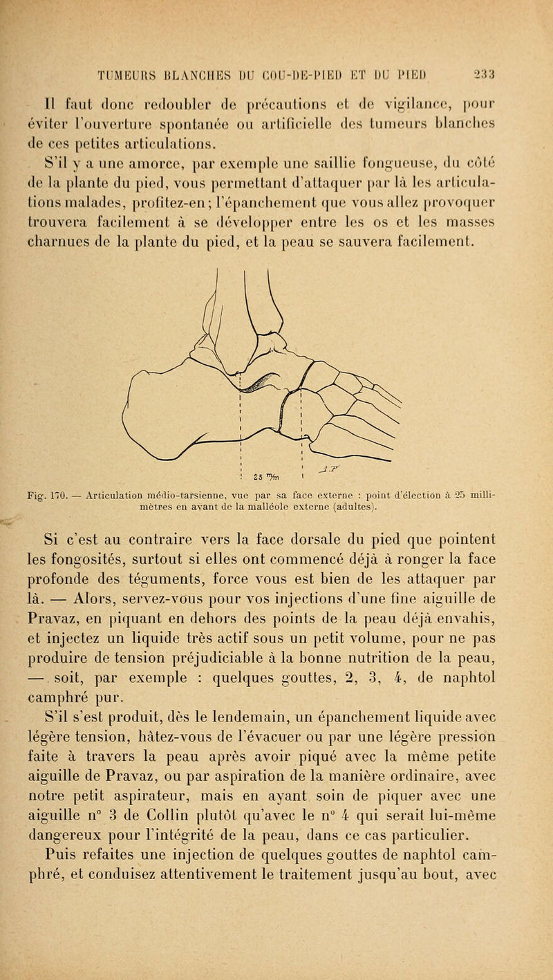 Il faut donc redoubler de [trécautions et de vii^ilauce, pour éviter l'ouverture spontanée ou artificielle des tumeurs blanches de ces petites articulations. S'il y a une amorce, par exem[)le une saillie fongueuse, du côté de la plante du pied, vous permettant d'attaquer par là les articula- tions malades, profitez-en; l'épanchement que vous allez provoquer trouvera facilement à se développer entre les os et les masses charnues de la plante du pied, et la peau se sauvera facilement. Fig. 170. — Articulation médio-tarsienne, vue par sa face externe : point d'élection à 25 milli- mètres en avant de la malléole externe (adultes). Si c'est au contraire vers la face dorsale du pied que pointent les fongosités, surtout si elles ont commencé déjà à ronger la face profonde des téguments, force vous est bien de les attaquer par là. — Alors, servez-vous pour vos injections d'une fine aiguille de Pravaz, en piquant en dehors des points de la peau déjà envahis, et injectez un liquide très actif sous un petit volume, pour ne pas produire de tension préjudiciable à la bonne nutrition de la peau, — soit, par exemple : quelques gouttes, 2, 3, 4, de naphtol camphré pur. S'il s'est produit, dès le lendemain, un épanchement liquide avec légère tension, hâtez-vous de l'évacuer ou par une légère pression faite à travers la peau après avoir piqué avec la même petite aiguille de Pravaz, ou par aspiration de la manière ordinaire, avec notre petit aspirateur, mais en ayant soin de piquer avec une aig'uille n° 3 de Collin plutôt qu'avec le n° 4 qui serait lui-même dang-ereux pour l'intég'rité de la peau, dans ce cas particulier. Puis refaites une injection de quelques gouttes de naphtol cam- phré, et conduisez attentivement le traitement jusqu'au bout, avec