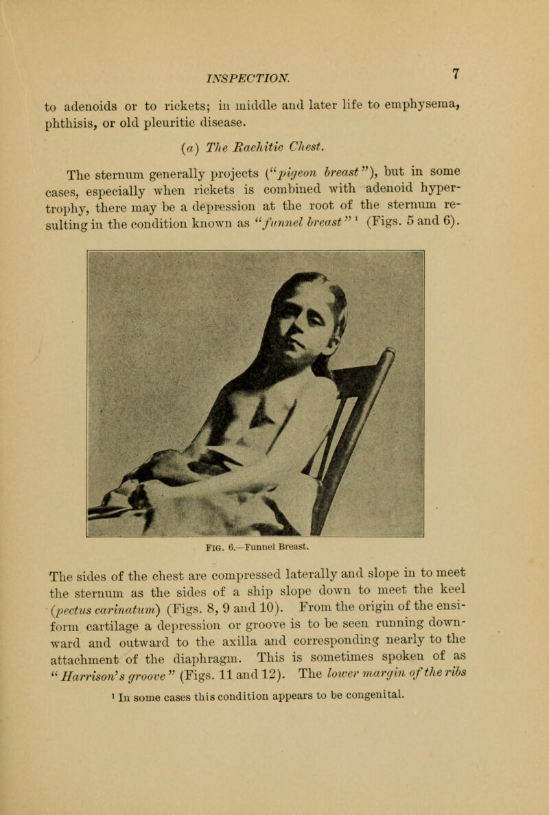 to adenoids or to rickets; in middle and later life to emphysema, phthisis, or old pleuritic disease. (a) The Rachitic Chest. The sternum generally projects {pigeon breast), but in some cases, especially when rickets is combined with adenoid hyper- trophy, there may be a depression at the root of the sternum re- sulting in the condition known as funnel breast  * (Figs. 5 and 6). FIG. 6.—Funnel Breast. The sides of the chest are compressed laterally and slope in to meet the sternum as the sides of a ship slope down to meet the keel {pectus carinatum) (Figs. 8, 9 and 10). From the origin of the ensi- form cartilage a depression or groove is to be seen running down- ward and outward to the axilla and corresponding nearly to the attachment of the diaphragm. This is sometimes spoken of as  Harrison's groove  (Figs. 11 and 12). The lower margin of the ribs 1 In some cases this condition appears to be congenital.