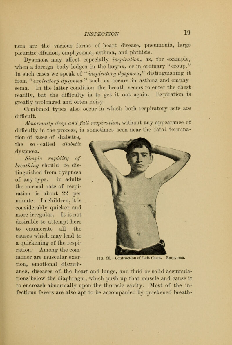 noea are the various forms of heart disease, pneumonia, large pleuritic effusion, emphysema, asthma, and phthisis. Dyspnoea may affect especially inspiration, as, for example, when a foreign body lodges in the larynx, or in ordinary croup. In such cases we speak of inspiratory dyspnoea distinguishing it from  expiratory dyspnoea  such as occurs in asthma and emphy- sema. In the latter condition the breath seems to enter the chest readily, but the difficulty is to get it out again. Expiration is greatly prolonged and often noisy. Combined types also occur in which both respiratory acts are difficult. Abnormally deep and full respiration, without any appearance of difficulty in the process, is sometimes seen near the fatal termina- tion of cases of diabetes, the so - called diabetic dyspnoea. Simple rapidity of breathing should be dis- tinguished from dyspnoea of any type. In adults the normal rate of respi- ration is about 22 per minute. In children, it is considerably quicker and more irregular. It is not desirable to attempt here to enumerate all the causes which may lead to a quickening of the respi- ration. Among the com- moner are muscular exer- tion, emotional disturb- ance, diseases of the heart and lungs, and fluid or solid accumula- tions below the diaphragm, which push up that muscle and cause it to encroach abnormally upon the thoracic cavity. Most of the in- fectious fevers are also apt to be accompanied by quickened breath- Fig. 20.—Con traction of Left Chest. Empyema.