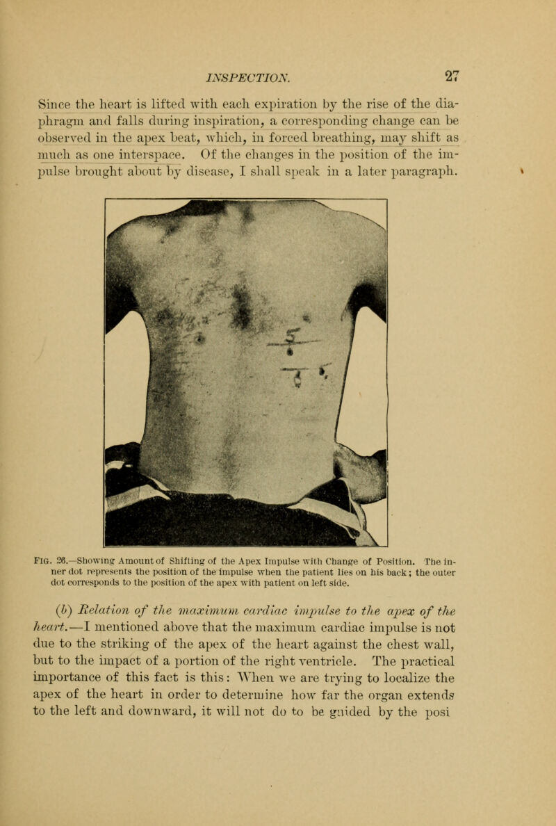 Since the heart is lifted with each expiration by the rise of the dia- phragm and falls during inspiration, a corresponding change can be observed in the apex beat, which, in forced breathing, may shift as much as one interspace. Of the changes in the position of the im- pulse brought about by disease, I shall speak in a later paragraph. Fig. 26.—Showing Amount of Shifting of the Apex Impulse with Change of Position. The in- ner dot represents the position of the impulse when the patient lies on his back; the outer dot corresponds to the position of the apex with patient on left side. (U) Relation of the maximum cardiac impulse to the apex of the heart.—I mentioned above that the maximum cardiac impulse is not due to the striking of the apex of the heart against the chest wall, but to the impact of a portion of the right ventricle. The practical importance of this fact is this: When we are trying to localize the apex of the heart in order to determine how far the organ extends to the left and downward, it will not do to be guided by the posi