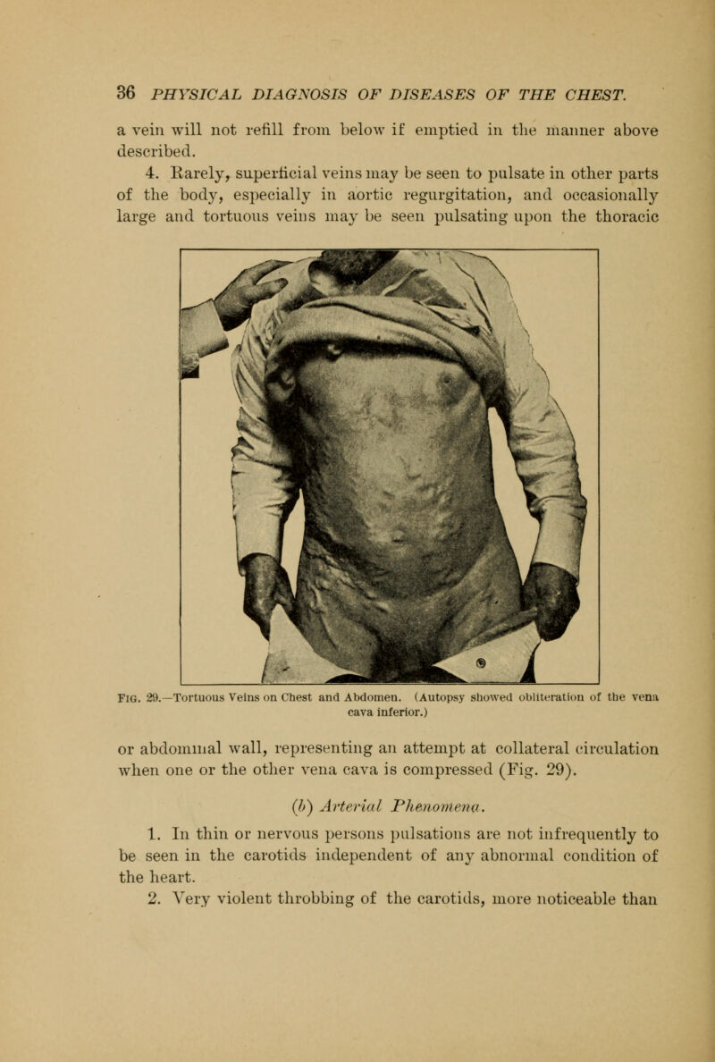 a vein will not refill from below if emptied in the manner above described. 4. Rarely, superficial veins may be seen to pulsate in other parts of the body, especially in aortic regurgitation, and occasionally large and tortuous veins may be seen pulsating upon the thoracic Fig. 29.—Tortuous Veins on Chest and Abdomen. (Autopsy showed obliteration of the vena cava inferior.) or abdominal wall, representing an attempt at collateral circulation when one or the other vena cava is compressed (Fig. 29). (b) Arterial Phenomena. 1. In thin or nervous persons pulsations are not infrequently to be seen in the carotids independent of any abnormal condition of the heart. 2. Very violent throbbing of the carotids, more noticeable than