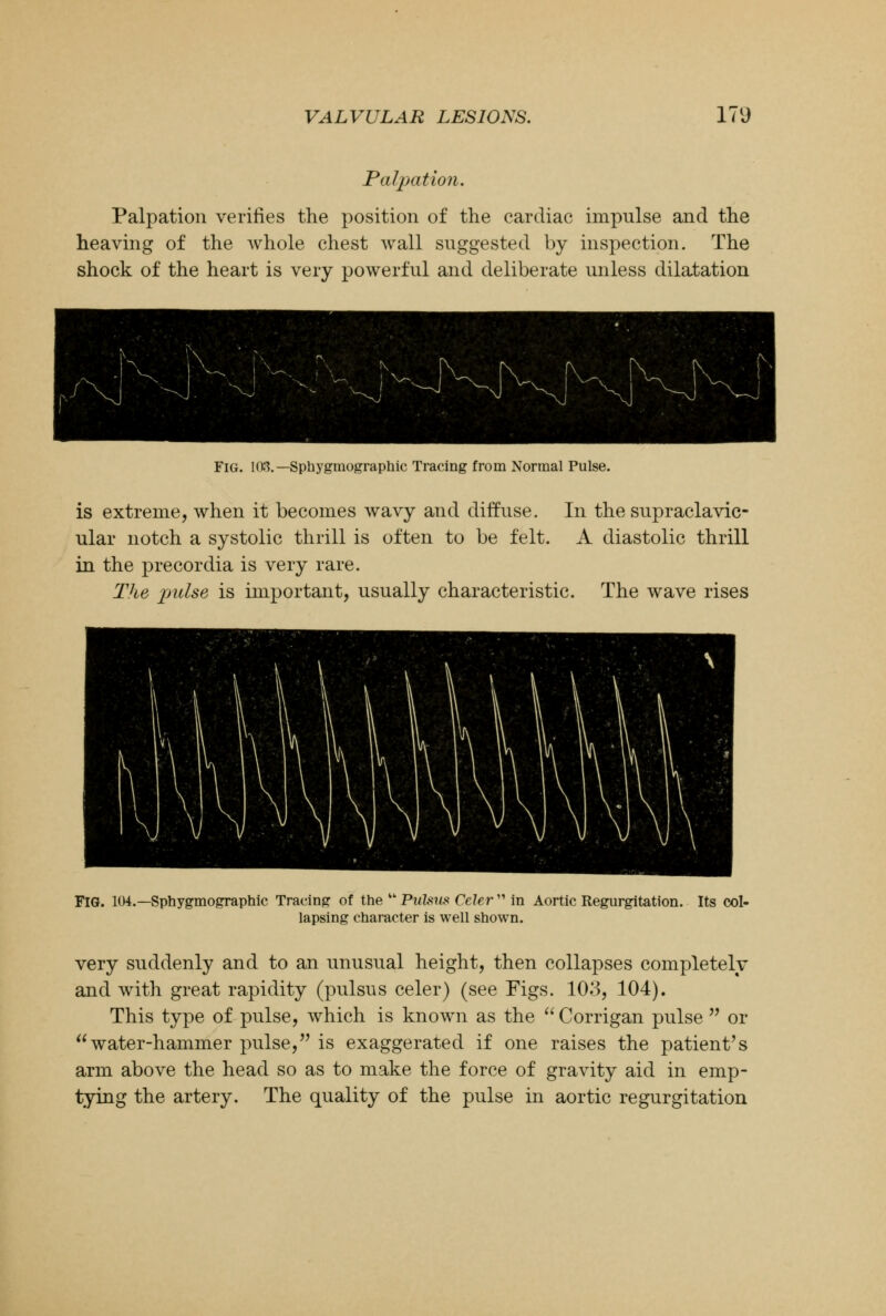 Palpation. Palpation verifies the position of the cardiac impulse and the heaving of the whole chest wall suggested by inspection. The shock of the heart is very powerful and deliberate unless dilatation Fig. 103.— Sphygmographic Tracing from Normal Pulse. is extreme, when it becomes wavy and diffuse. ular notch a systolic thrill is often to be felt. in the precordia is very rare. The jnclse is important, usually characteristic In the supraclavic- A diastolic thrill The wave rises FIG. 104.— Sphygmographic Tracing of the  Pulsus Celer  in Aortic Regurgitation. Its col- lapsing character is well shown. very suddenly and to an unusual height, then collapses completely and with great rapidity (pulsus celer) (see Figs. 103, 104). This type of pulse, which is known as the  Corrigan pulse  or water-hammer pulse, is exaggerated if one raises the patient's arm above the head so as to make the force of gravity aid in emp- tying the artery. The quality of the pulse in aortic regurgitation