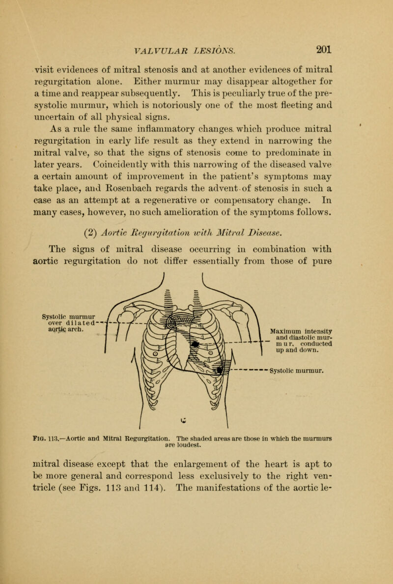 visit evidences of mitral stenosis and at another evidences of mitral regurgitation alone. Either murmur may disappear altogether for a time and reappear subsequently. This is peculiarly true of the pre- systolic murmur, which is notoriously one of the most fleeting and uncertain of all physical signs. As a rule the same inflammatory changes, which produce mitral regurgitation in early life result as they extend in narrowing the mitral valve, so that the signs of stenosis come to predominate in later years. Coincidently with this narrowing of the diseased valve a certain amount of improvement in the patient's symptoms may take place, and Rosenbach regards the advent-of stenosis in such a case as an attempt at a regenerative or compensatory change. In many cases, however, no such amelioration of the symptoms follows. (2) Aortic Regurgitation with Mitral Disease. The signs of mitral disease occurring in combination with aortic regurgitation do not differ essentially from those of pure Systolic murmur over dilated-—f-—' aortic, arch. Maximum intensity and diastolic mur- mur, conducted up and down. ••Systolic murmur. Fig. 113.—Aortic and Mitral Regurgitation. The shaded areas are those in which the murmurs are loudest. mitral disease except that the enlargement of the heart is apt to be more general and correspond less exclusively to the right ven- tricle (see Figs. 113 and 114). The manifestations of the aortic le-