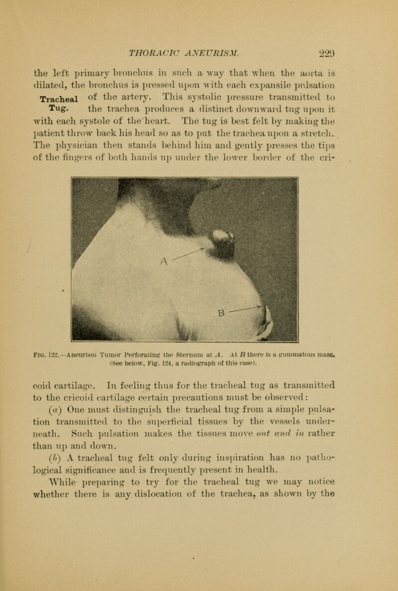 the left primary bronchus in such a way that when the aorta is dilated, the bronchus is pressed upon with each expansile pulsation Tracheal or> the artery. This systolic pressure transmitted to Tug. the trachea produces a distinct downward tug upon it with each systole of the'heart. The tug is best felt by making the patient throw baek his head so as to put the trachea upon a stretch. The physician then stands behind him and gently presses the tips of the fingers of both hands Tip under the lower border of the cri- Fig. 122.—Aneurism Tumor Perforating the Sternum at A. At B there is a gummatous mass. (See below. Fig. 124, a radiograph of this case). coid cartilage. In feeling thus for the tracheal tug as transmitted to the cricoid cartilage certain precautions must be observed : (ft) One must distinguish the tracheal tug from a simple pulsa- tion transmitted to the superficial tissues by the vessels under- neath. Such pulsation makes the tissues move out and in rather than up and down. (It) A tracheal tug felt only during inspiration has no patho- logical significance and is frequently present in health. While preparing to try for the tracheal tug we may notice whether there is any dislocation of the trachea, as shown by the