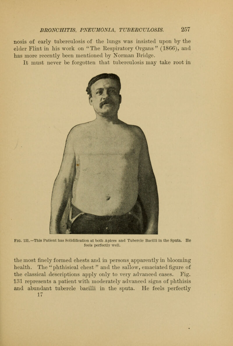 nosis of early tuberculosis of the lungs was insisted upon by the eider Flint in his work on The Respiratory Organs (1866), and has more recently been mentioned by Norman Bridge. It must never be forgotten that tuberculosis may take root in FIG. 131.—This Patient has Solidification at both Apices and Tubercle Bacilli in the Sputa. feels perfectly well. He the most finely formed chests and in persons apparently in blooming health. The phthisical chest  and the sallow, emaciated figure of the classical descriptions apply only to very advanced cases. Fig. 131 represents a patient with moderately advanced signs of phthisis and abundant tubercle bacilli in the sputa. He feels perfectly 17