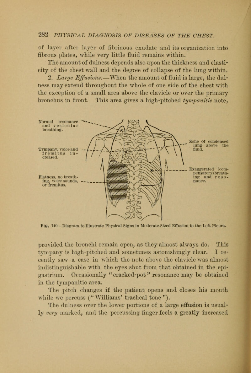 of layer after layer of fibrinous exudate and its organization into fibrous plates, while very little fluid remains within. The amount of dulness depends also upon the thickness and elasti- city of the chest wall and the degree of collapse of the lung within. 2. Large Effusions.—When the amount of fluid is large, the dul- ness may extend throughout the whole of one side of the chest with the exception of a small area above the clavicle or over the primary bronchus in front. This area gives a high-pitched tympanitic note, Normal resonance and vesicular breathing. Tympany, voice and fremitus i n - creased. Flatness, no breath- ing, voice sounds, or fremitus. Zone of condensed lung above the fluid. Exaggerated (com- pensatory) breath- ing and reso- nance. Fig. 140. -Diagram to Illustrate Physical Signs in Moderate-Sized Effusion in the Left Pleura. provided the bronchi remain open, as they almost always do. This tympany is high-pitched and sometimes astonishingly clear. I re- cently saw a case in which the note above the clavicle was almost indistinguishable with the eyes shut from that obtained in the epi- gastrium. Occasionally  cracked-pot resonance may be obtained in the tympanitic area. The pitch changes if the patient opens and closes his mouth while we percuss (Williams' tracheal tone). The dulness over the lower portions of a large effusion is usual- ly very marked, and the percussing ringer feels a greatly increased