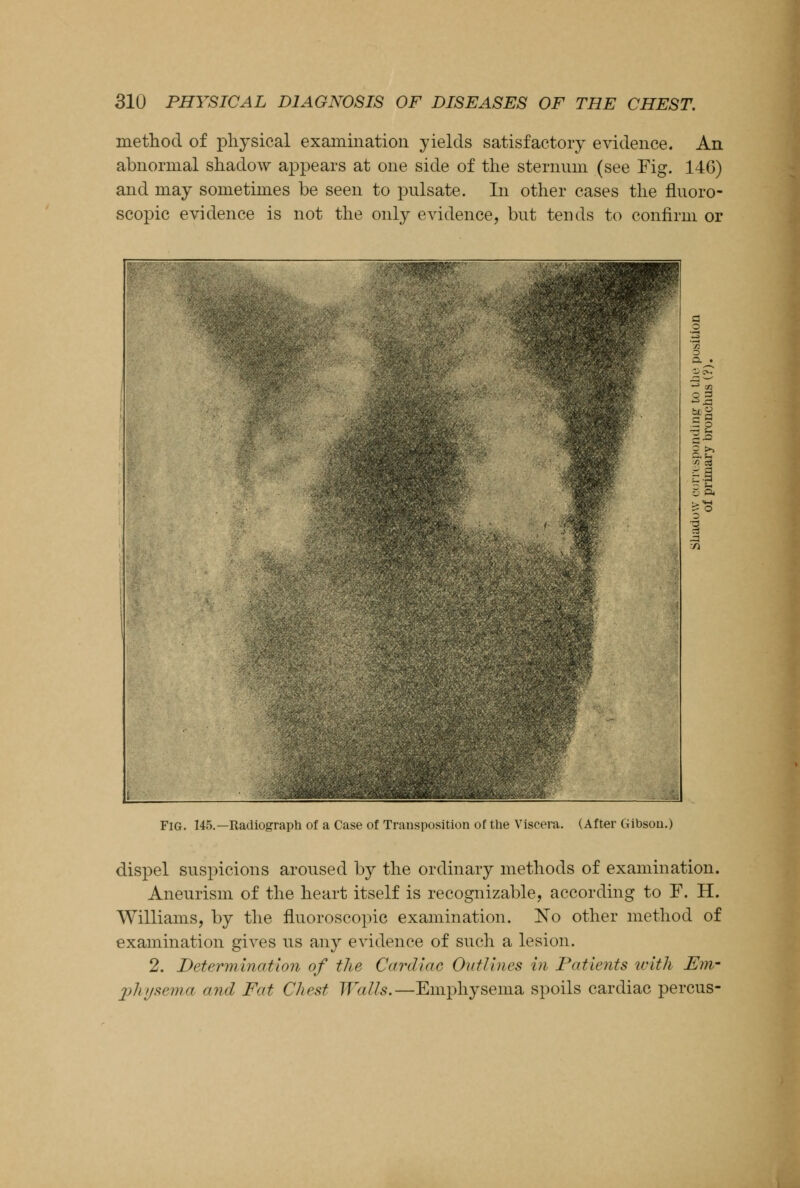 method of physical examination yields satisfactory evidence. An abnormal shadow appears at one side of the sternum (see Fig. 14G) and may sometimes be seen to pulsate. In other cases the fluoro- scopic evidence is not the only evidence, but tends to confirm or Fig. 145.—Radiograph of a Case of Transposition of the Viscera. (After Gibson.) dispel suspicions aroused by the ordinary methods of examination. Aneurism of the heart itself is recognizable, according to F. H. Williams, by the fluoroscopic examination. No other method of examination gives us any evidence of such a lesion. 2. Determination of the Cardiac, Outlines in Patients with Em- physema and Fat Chest Walls.—Emphysema spoils cardiac percus-