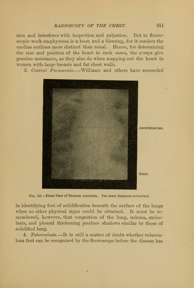 sion and interferes with, inspection and palpation. But in fluoro- scopic work emphysema is a boon and a blessing, for it renders the cardiac outlines more distinct than usual. Hence, for determining the size and position of the heart in such cases, the cc-rays give genuine assistance, as they also do when mapping out the heart in women with large breasts and fat chest walls. 3. Central Pneumonia.—Williams and others have succeeded Aneurismal sac. Heart. Fig. 146.—Front View of Thoracic Aneurism. The heart displaced downward. in identifying foci of solidification beneath the surface of the lungs when no other physical signs could be obtained. It must be re- membered, however, that congestion of the lung, oedema, atelec- tasis, and pleural thickening produce shadows similar to those of solidified lung. 4. Tuberculosis.—It is still a matter of doubt whether tubercu- lous foci can be recognized by the fluoroscope before the disease has