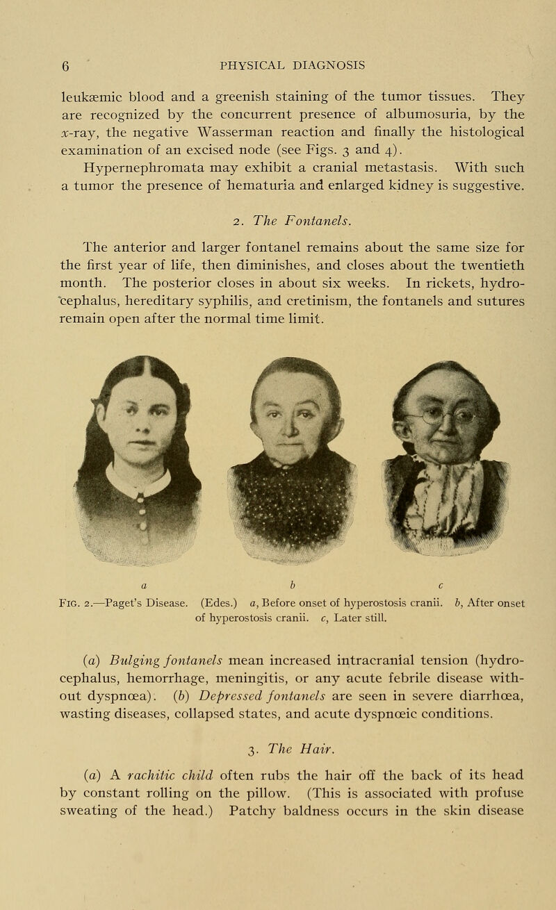 leuksemic blood and a greenish staining of the tumor tissues. They are recognized by the concurrent presence of albumosuria, by the x-ray, the negative Wasserman reaction and finally the histological examination of an excised node (see Figs. 3 and 4). Hypernephromata may exhibit a cranial metastasis. With such a tumor the presence of hematuria and enlarged kidney is suggestive. 2. The Fontanels. The anterior and larger fontanel remains about the same size for the first year of life, then diminishes, and closes about the twentieth month. The posterior closes in about six weeks. In rickets, hydro- cephalus, hereditary syphilis, and cretinism, the fontanels and sutures remain open after the normal time limit. a b c Fig. 2.—Paget's Disease. (Edes.) a, Before onset of hyperostosis cranii. b, After onset of hyperostosis cranii. c, Later still. (a) Bulging fontanels mean increased intracranial tension (hydro- cephalus, hemorrhage, meningitis, or any acute febrile disease with- out dyspnoea). (b) Depressed fontanels are seen in severe diarrhoea, wasting diseases, collapsed states, and acute dyspnceic conditions. 3. The Hair. (a) A rachitic child often rubs the hair off the back of its head by constant rolling on the pillow. (This is associated with profuse sweating of the head.) Patchy baldness occurs in the skin disease
