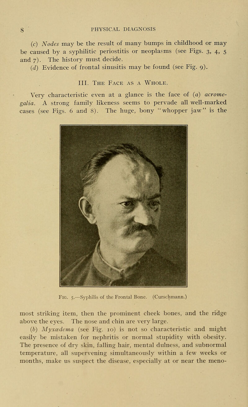 (c) Nodes may be the result of many bumps in childhood or may be caused by a syphilitic periostitis or neoplasms (see Figs. 3, 4, 5 and 7). The history must decide. (d) Evidence of frontal sinusitis may be found (see Fig. 9). III. The Face as a Whole. Very characteristic even at a glance is the face of (a) acrome- galia. A strong family likeness seems to pervade all well-marked cases (see Figs. 6 and 8). The huge, bony whopper jaw is the ^ijW : 1 ■ wL jjT Fig. 5.—Syphilis of the Frontal Bone. (Curschmann.) most striking item, then the prominent cheek bones, and the ridge above the eyes. The nose and chin are very large. (b) Myxcedema (see Fig. 10) is not so characteristic and might easily be mistaken for nephritis or normal stupidity with obesity. The presence of dry skin, falling hair, mental dulness, and subnormal temperature, all supervening simultaneously within a few weeks or months, make us suspect the disease, especially at or near the meno-
