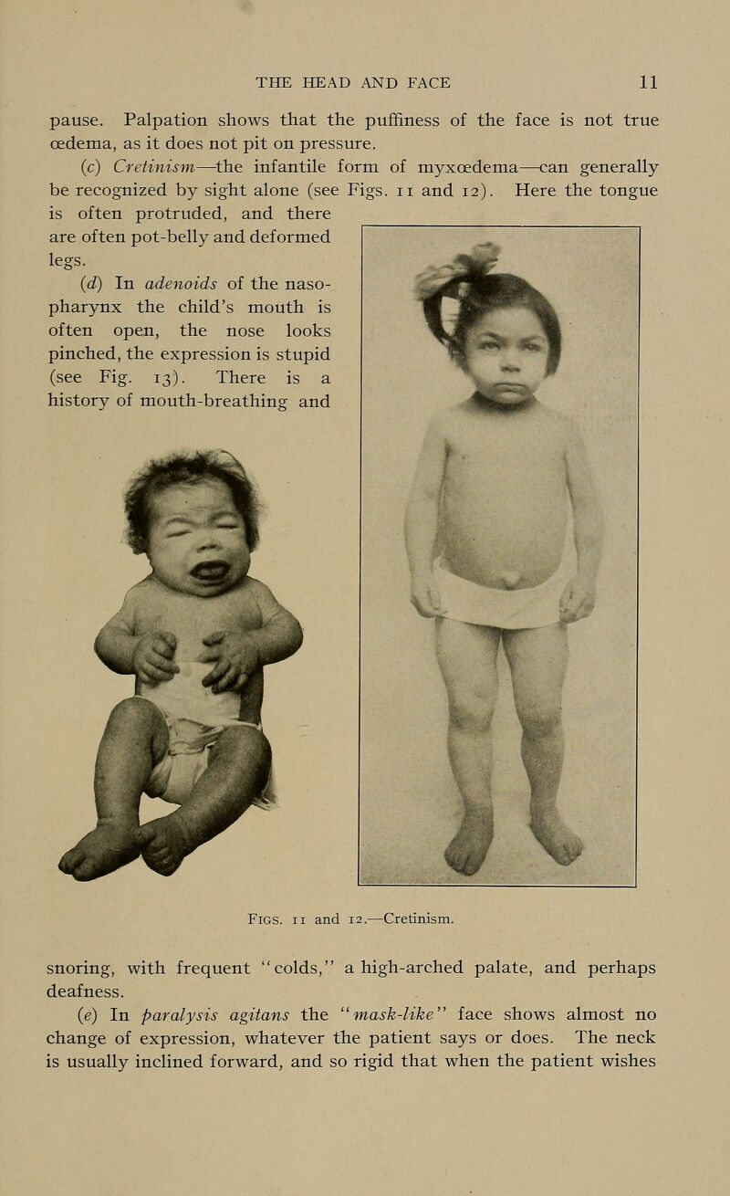 pause. Palpation shows that the puffiness of the face is not true oedema, as it does not pit on pressure. (c) Cretinism—the infantile form of myxoedema—can generally be recognized by sight alone (see Figs, n and 12). Here the tongue is often protruded, and there are often pot-belly and deformed legs. (d) In adenoids of the naso- pharynx the child's mouth is often open, the nose looks pinched, the expression is stupid (see Fig. 13). There is a history of mouth-breathing and Figs, ii and 12.—Cretinism. snoring, with frequent colds, a high-arched palate, and perhaps deafness. (e) In paralysis agitans the mask-like face shows almost no change of expression, whatever the patient says or does. The neck is usually inclined forward, and so rigid that when the patient wishes