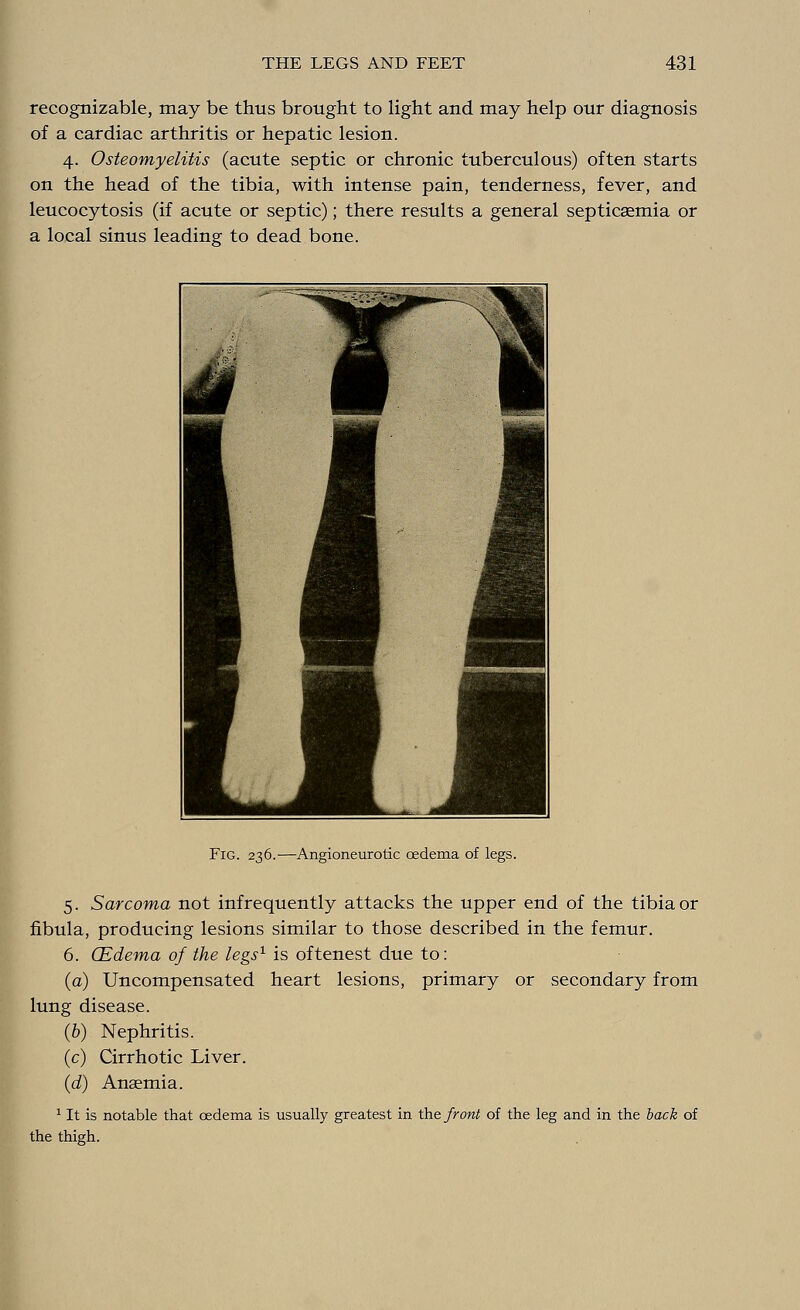 recognizable, may be thus brought to light and may help our diagnosis of a cardiac arthritis or hepatic lesion. 4. Osteomyelitis (acute septic or chronic tuberculous) often starts on the head of the tibia, with intense pain, tenderness, fever, and leucocytosis (if acute or septic); there results a general septicaemia or a local sinus leading to dead bone. Fig. 236.—Angioneurotic oedema of legs. 5. Sarcoma not infrequently attacks the upper end of the tibia or fibula, producing lesions similar to those described in the femur. 6. (Edema of the legs1 is oftenest due to: (a) Uncompensated heart lesions, primary or secondary from lung disease. (6) Nephritis. (c) Cirrhotic Liver. (d) Anaemia. 1 It is notable that oedema is usually greatest in the front of the leg and in the back of the thigh.
