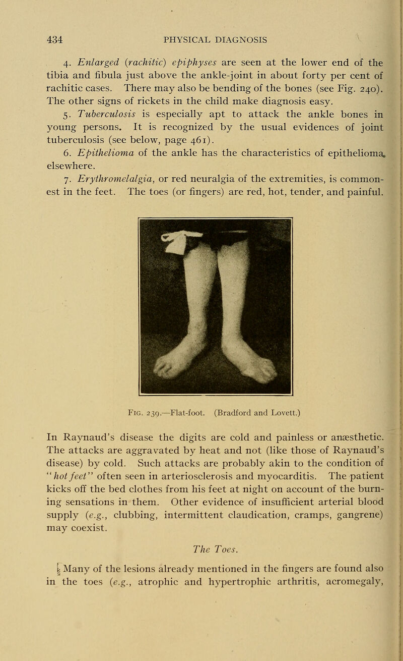 4. Enlarged (rachitic) epiphyses are seen at the lower end of the tibia and fibula just above the ankle-joint in about forty per cent of rachitic cases. There may also be bending of the bones (see Fig. 240). The other signs of rickets in the child make diagnosis easy. 5. Tuberculosis is especially apt to attack the ankle bones in young persons. It is recognized by the usual evidences of joint tuberculosis (see below, page 461). 6. Epithelioma of the ankle has the characteristics of epithelioma, elsewhere. 7. Erythromelalgia, or red neuralgia of the extremities, is common- est in the feet. The toes (or fingers) are red, hot, tender, and painful. Fig. 239.—Flat-foot. (Bradford and Lovett.) In Raynaud's disease the digits are cold and painless or anaesthetic. The attacks are aggravated by heat and not (like those of Raynaud's disease) by cold. Such attacks are probably akin to the condition of hot feet often seen in arteriosclerosis and myocarditis. The patient kicks off the bed clothes from his feet at night on account of the burn- ing sensations in them. Other evidence of insufficient arterial blood supply (e.g., clubbing, intermittent claudication, cramps, gangrene) may coexist. The Toes. \ Many of the lesions already mentioned in the fingers are found also in the toes (e.g., atrophic and hypertrophic arthritis, acromegaly,