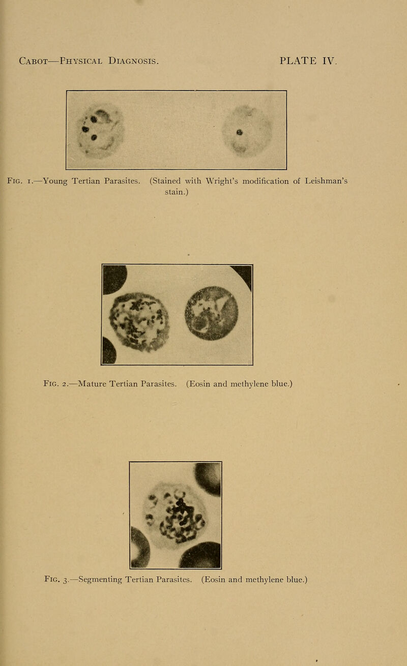 Fig. i.—Young Tertian Parasites. (Stained with Wright's modification of Leishman's stain.) Fig. 2.—Mature Tertian Parasites. (Eosin and methylene blue.) Fig. 3.—Segmenting Tertian Parasites. (Eosin and methylene blue.)