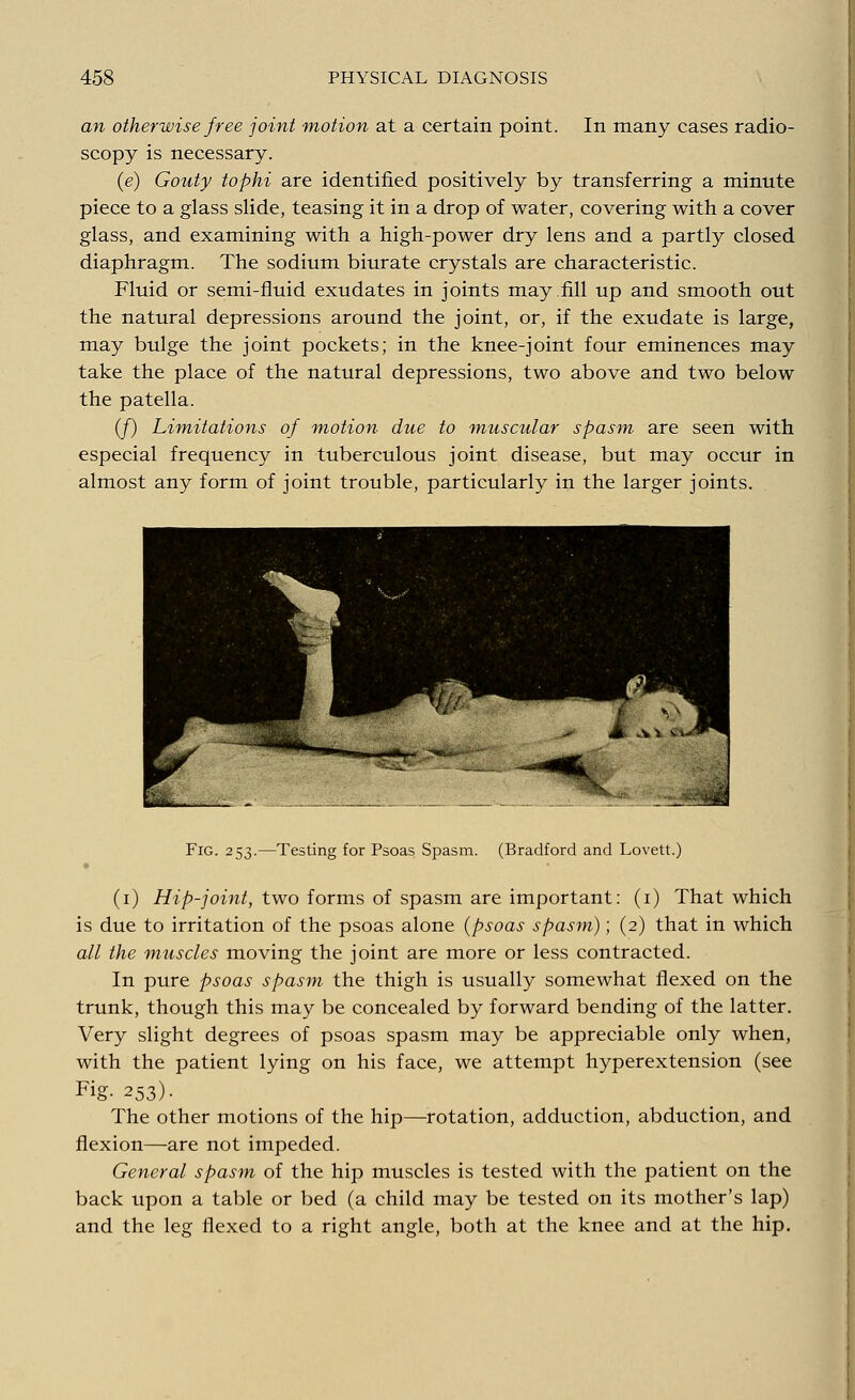 an otherwise free joint motion at a certain point. In many cases radio- scopy is necessary. (e) Gouty tophi are identified positively by transferring a minute piece to a glass slide, teasing it in a drop of water, covering with a cover glass, and examining with a high-power dry lens and a partly closed diaphragm. The sodium biurate crystals are characteristic. Fluid or semi-fluid exudates in joints may fill up and smooth out the natural depressions around the joint, or, if the exudate is large, may bulge the joint pockets; in the knee-joint four eminences may take the place of the natural depressions, two above and two below the patella. (/) Limitations of motion due to muscular spasm are seen with especial frequency in tuberculous joint disease, but may occur in almost any form of joint trouble, particularly in the larger joints. Fig. 253.—Testing for Psoas Spasm. (Bradford and Lovett.) (1) Hip-joint, two forms of spasm are important: (1) That which is due to irritation of the psoas alone (psoas spasm); (2) that in which all the muscles moving the joint are more or less contracted. In pure psoas spasm the thigh is usually somewhat flexed on the trunk, though this may be concealed by forward bending of the latter. Very slight degrees of psoas spasm may be appreciable only when, with the patient lying on his face, we attempt hyperextension (see Fig- 253). The other motions of the hip—rotation, adduction, abduction, and flexion—are not impeded. General spasm of the hip muscles is tested with the patient on the back upon a table or bed (a child may be tested on its mother's lap) and the leg flexed to a right angle, both at the knee and at the hip.