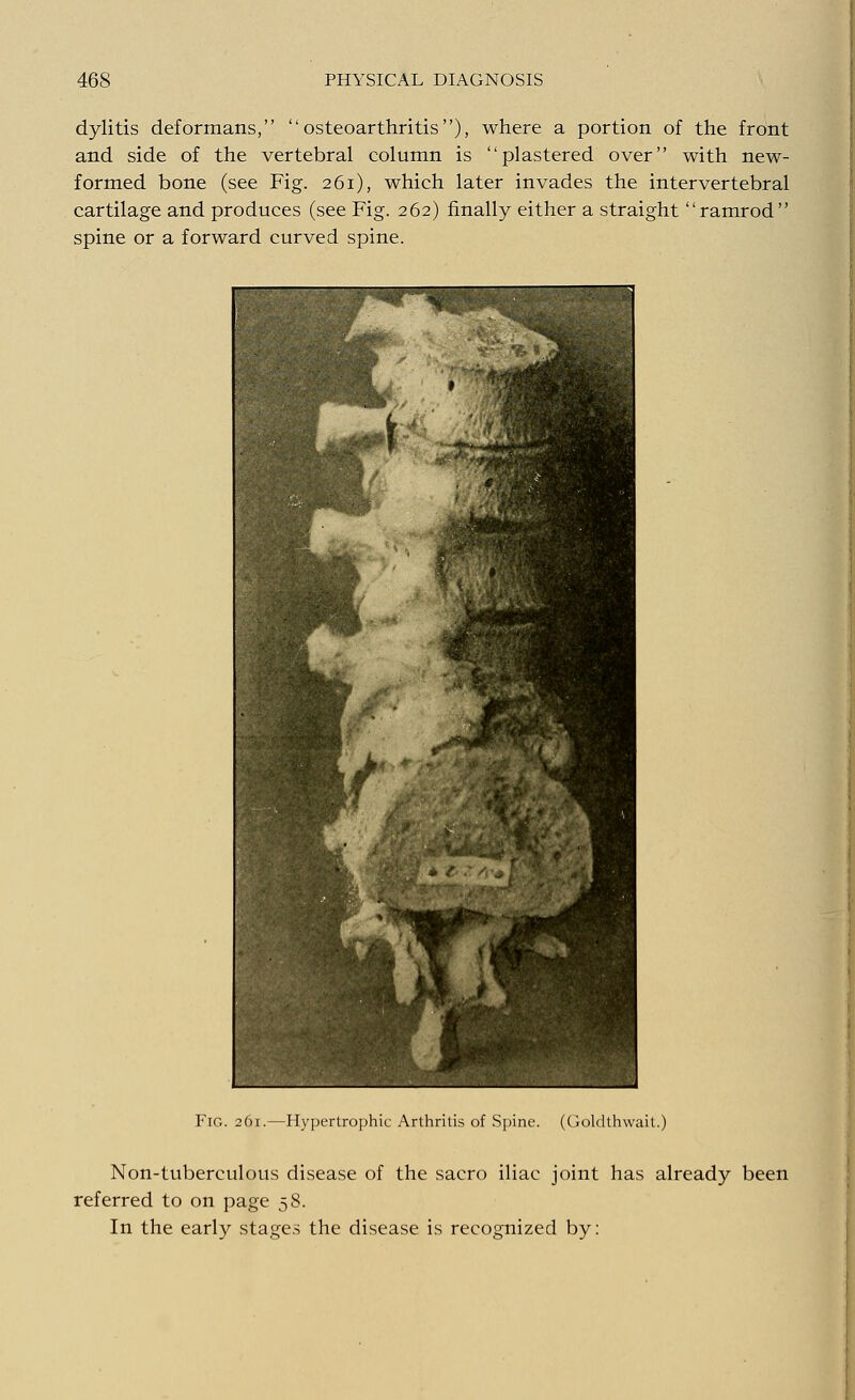 dylitis deformans, osteoarthritis), where a portion of the front and side of the vertebral column is plastered over with new- formed bone (see Fig. 261), which later invades the intervertebral cartilage and produces (see Fig. 262) finally either a straight ramrod spine or a forward curved spine. Fig. 261.—Hypertrophic Arthritis of Spine. (Goldthwait.) Non-tuberculous disease of the sacro iliac joint has already been referred to on page 58. In the early stages the disease is recognized by: