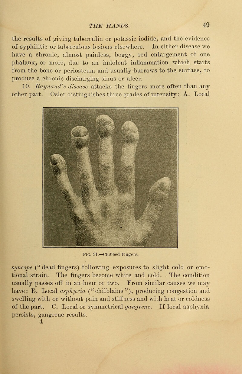 the results of giving tuberculin or potassic iodide, and the evidence of syphilitic or tuberculous lesions elsewhere. In either disease we have a chronic, almost painless, boggy, red enlargement of one phalanx, or more, due to an indolent inflammation which starts from the bone or periosteum and usually burrows to the surface, to produce a chronic discharging sinus or ulcer. 10. Raynaud/ s disease attacks the fingers more often than any other part. Osier distinguishes three grades of intensity: A. Local Clubbed Fingers. sijncope ( dead fingers) following exposures to slight cold or emo- tional strain. The fingers become white and cold. The condition usually passes off in an hour or two. From similar causes we may have: B. Local asphyxia (chilblains), producing congestion and swelling with or without pain and stiffness and with heat or coldness of the part. C. Local or symmetrical gangrene. If local asphyxia persists, gangrene results. 4