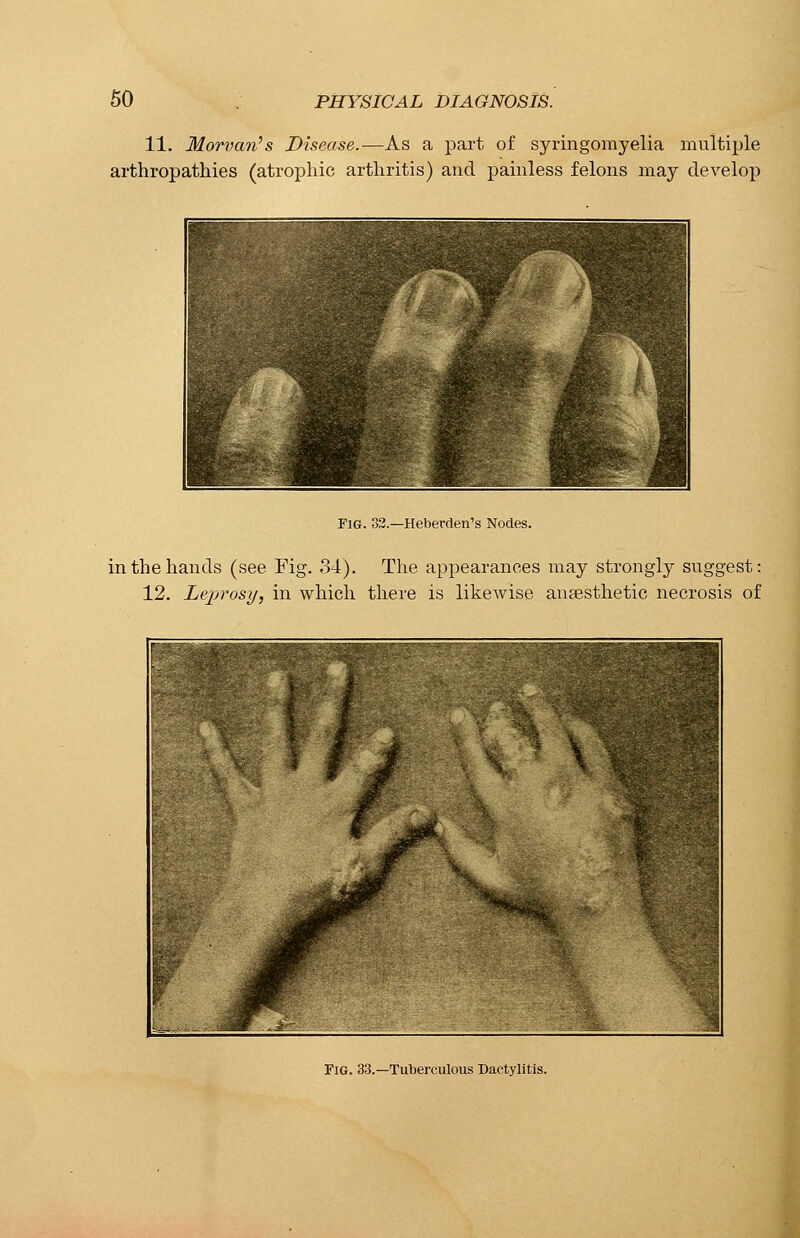 11. Morvan's Disease.—As a part of syringomyelia multiple arthropathies (atrophic arthritis) and painless felons may develop Fig. 32.—Heberden's Nodes. in the hands (see Fig. 34). The appearances may strongly suggest: 12. Leprosy, in which there is likewise anaesthetic necrosis of Fig. 33.—Tuberculous Dactylitis.