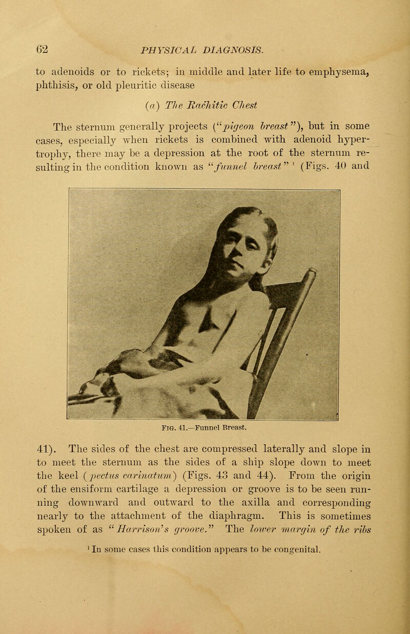 to adenoids or to rickets; in middle and later life to emphysema, phthisis, or old pleuritic disease (a) The Rachitic Chest The sternum generally projects (pigeon breast), but in some cases, especially when rickets is combined with adenoid hyper- trophy, there may be a depression at the root of the sternum re- sulting in the condition known as funnel breast''''1 (Figs. 40 and Fig. 41.—Funnel Breast. 41). The sides of the chest are compressed laterally and slope in to meet the sternum as the sides of a ship slope down to meet the keel (pectus carinatuni) (Figs. 43 and 44). From the origin of the ensiform cartilage a depression or groove is to be seen run- ning downward and outward to the axilla and corresponding nearly to the attachment of the diaphragm. This is sometimes spoken of as Harrison's groove. The lower margin of the ribs 1 In some cases this condition appears to be congenital.