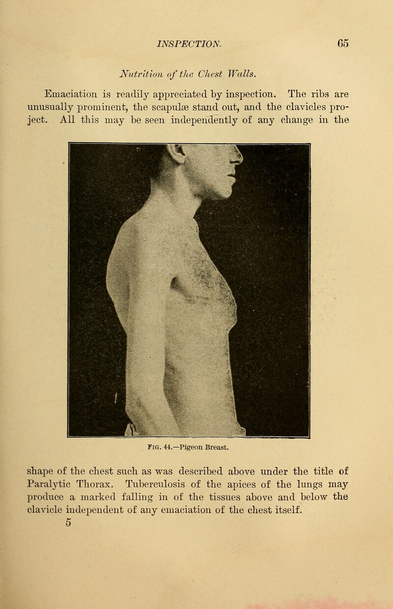 Nutrition of the Chest Walls. Emaciation is readily appreciated by inspection. The ribs are unusually prominent, the scapulae stand out, and the clavicles pro- ject. All this may be seen independently of any change in the Fig. 44.—Pigeon Breast. shape of the chest such as was described above under the title of Paralytic Thorax. Tuberculosis of the apices of the lungs may produce a marked falling in of the tissues above and below the clavicle independent of any emaciation of the chest itself. 5