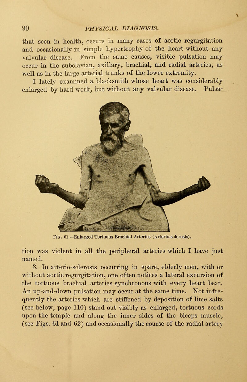 that seen in health, occurs in many cases of aortic regurgitation and occasionally in simple hypertrophy of the heart without any valvular disease. From the same causes, visible pulsation may occur in the subclavian, axillary, brachial, and radial arteries, as well as in the large arterial trunks of the lower extremity. I lately examined a blacksmith whose heart was considerably enlarged by hard work, but without any valvular disease. Pulsa- Fig. 61.—Enlarged Tortuous Brachial Arteries (Arterio-sclerosis). tion was violent in all the peripheral arteries which I have just named. 3. In arterio-sclerosis occurring in spare, elderly men, with or without aortic regurgitation, one often notices a lateral excursion of the tortuous brachial arteries synchronous with every heart beat. An up-and-down pulsation may occur at the same time. Not infre- quently the arteries which are stiffened by deposition of lime salts (see below, page 110) stand out visibly as enlarged, tortuous cords upon the temple and along the inner sides of the biceps muscle, (see Figs. 61 and 62) and occasionally the course of the radial artery