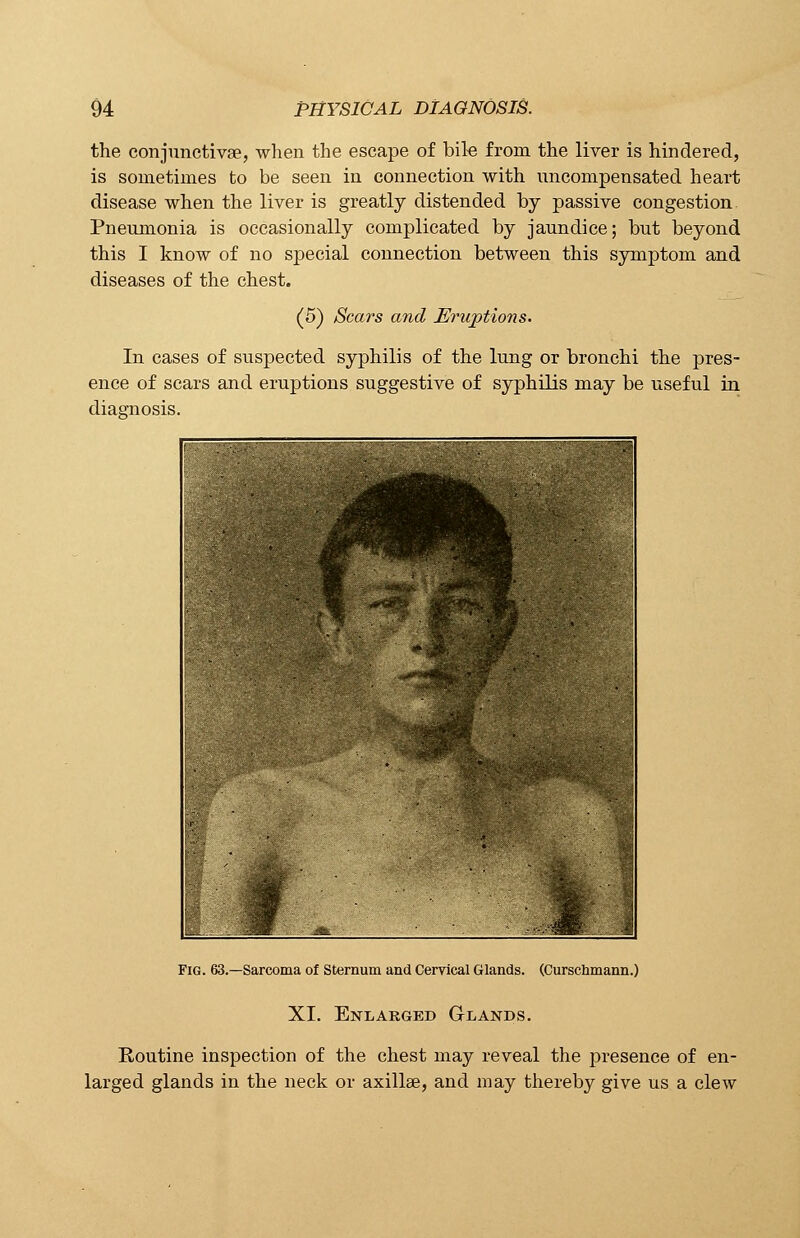 the conjunctivae, when the escape of bile from the liver is hindered, is sometimes to be seen in connection with uncompensated heart disease when the liver is greatly distended by passive congestion Pneumonia is occasionally complicated by jaundice; but beyond this I know of no special connection between this symptom and diseases of the chest. (5) Scars and Eruptions. In cases of suspected syphilis of the lung or bronchi the pres- ence of scars and eruptions suggestive of syphilis may be useful in diagnosis. Fig. 63.—Sarcoma of Sternum and Cervical Glands. (Curschmann.) XI. Enlarged Glands. Routine inspection of the chest may reveal the presence of en- larged glands in the neck or axilla?, and may thereby give us a clew